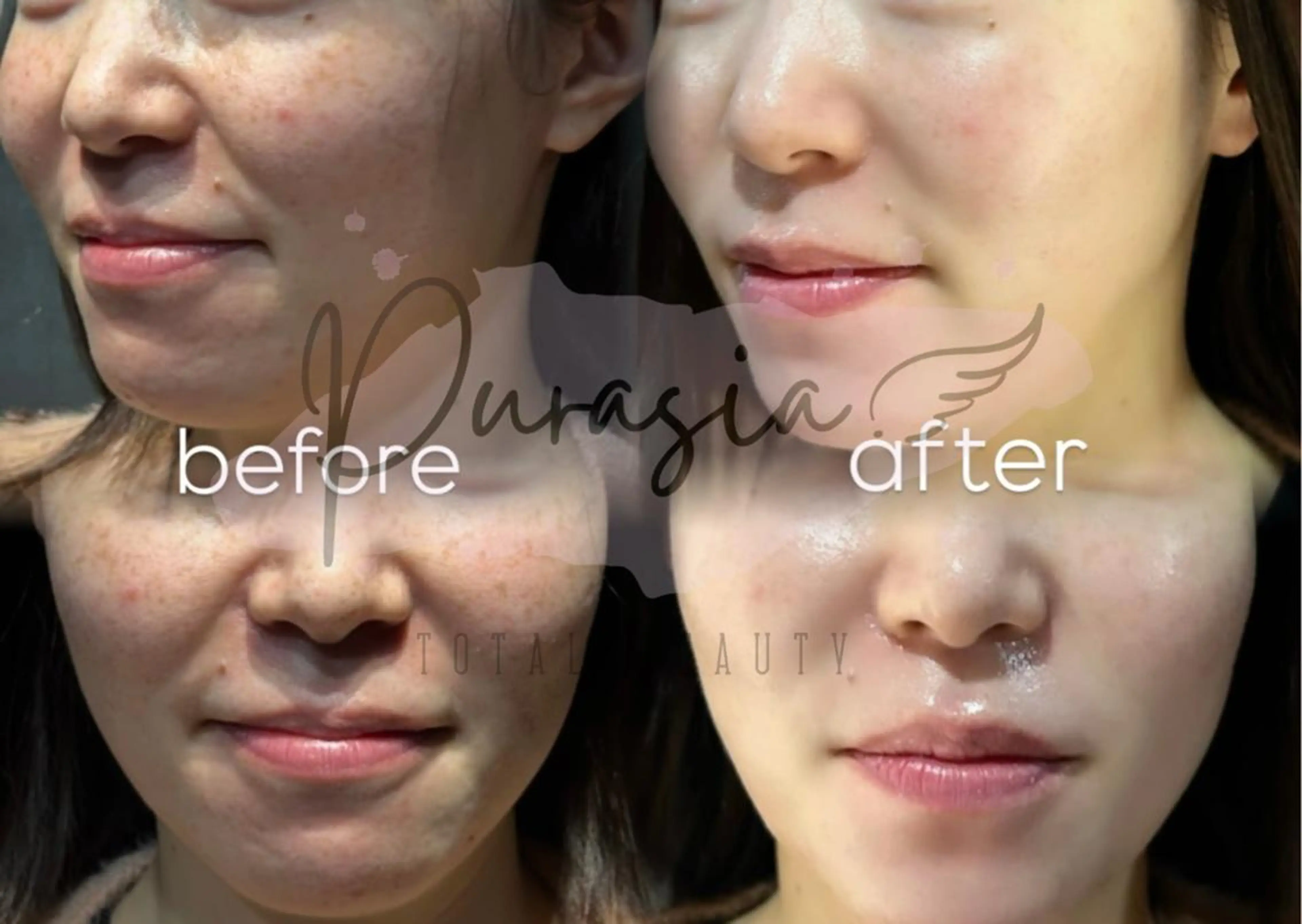 ⭐12月末まで35%OFF⭐水光ハーブピーリング×美肌LED照射×幹細胞マスク⭐ニキビや毛穴やくすみ改善⭐の写真