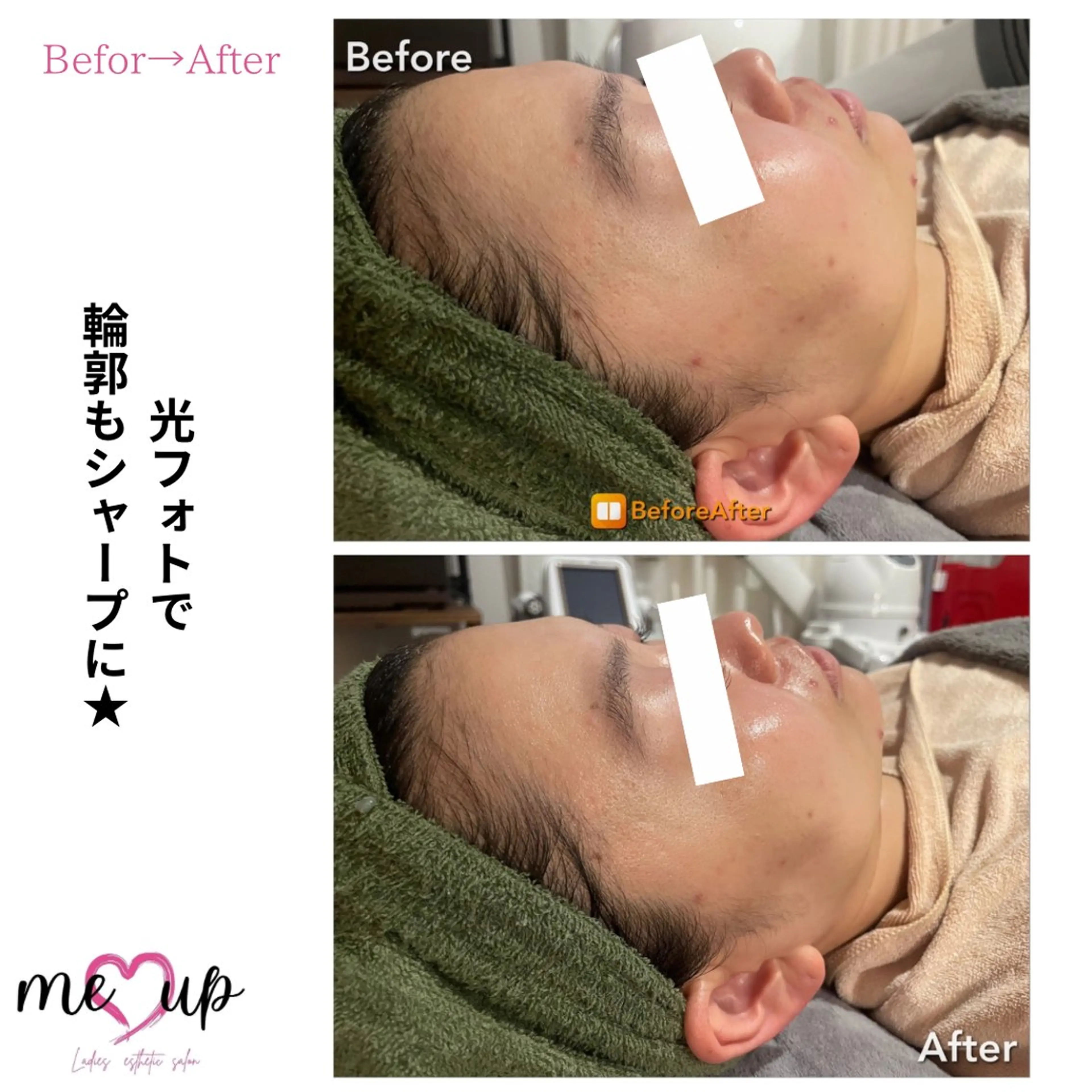 エステ Meupニキビ専門店 背中/ハーブ/ララのその他イメージ