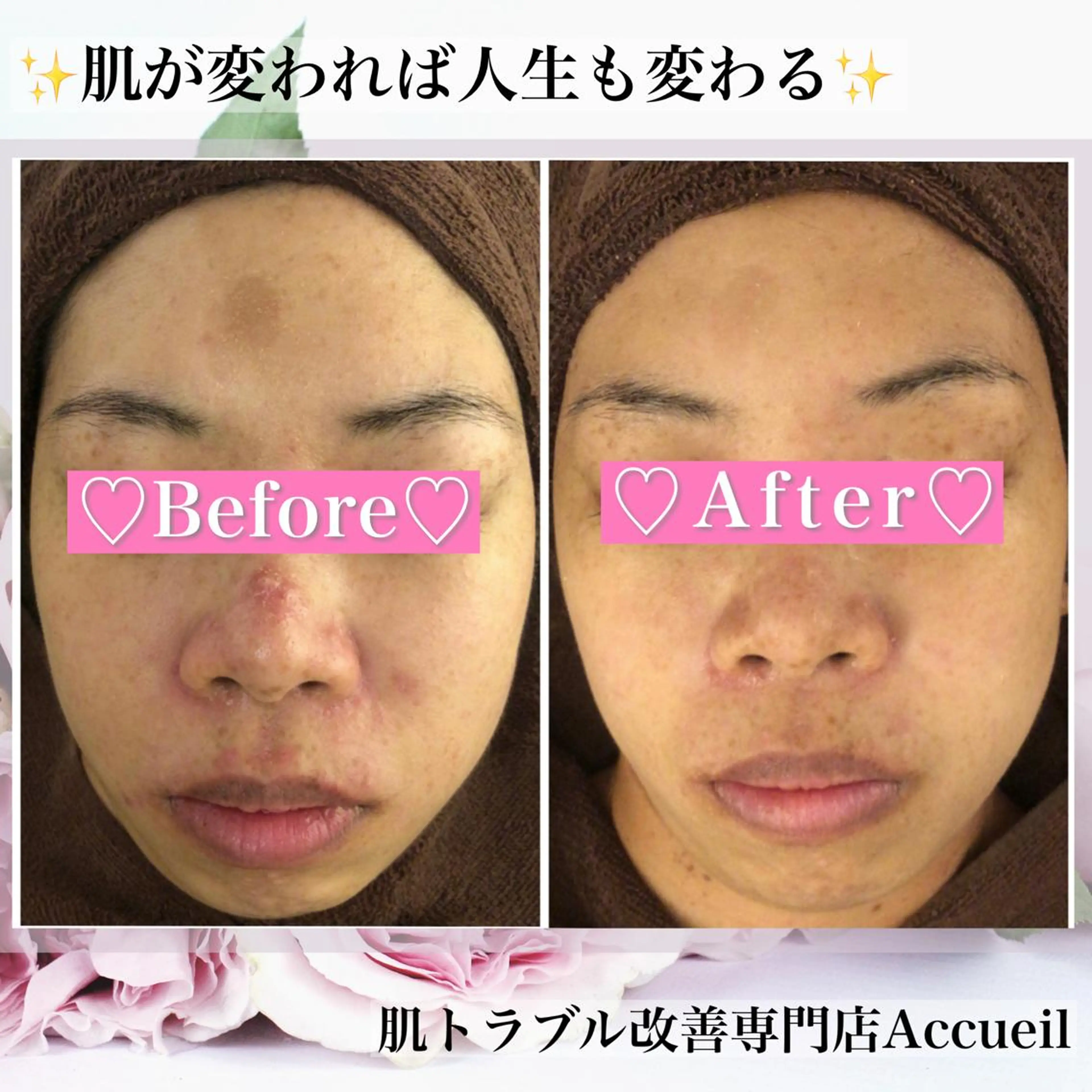 セミロング カラー パーマ ヘアアレンジ メンズ キッズ ネイル マツエク・マツパ アイブロウ エステ リラク アクール　齋藤 ♡肌トラブル卒業のエステ・リラクイメージ