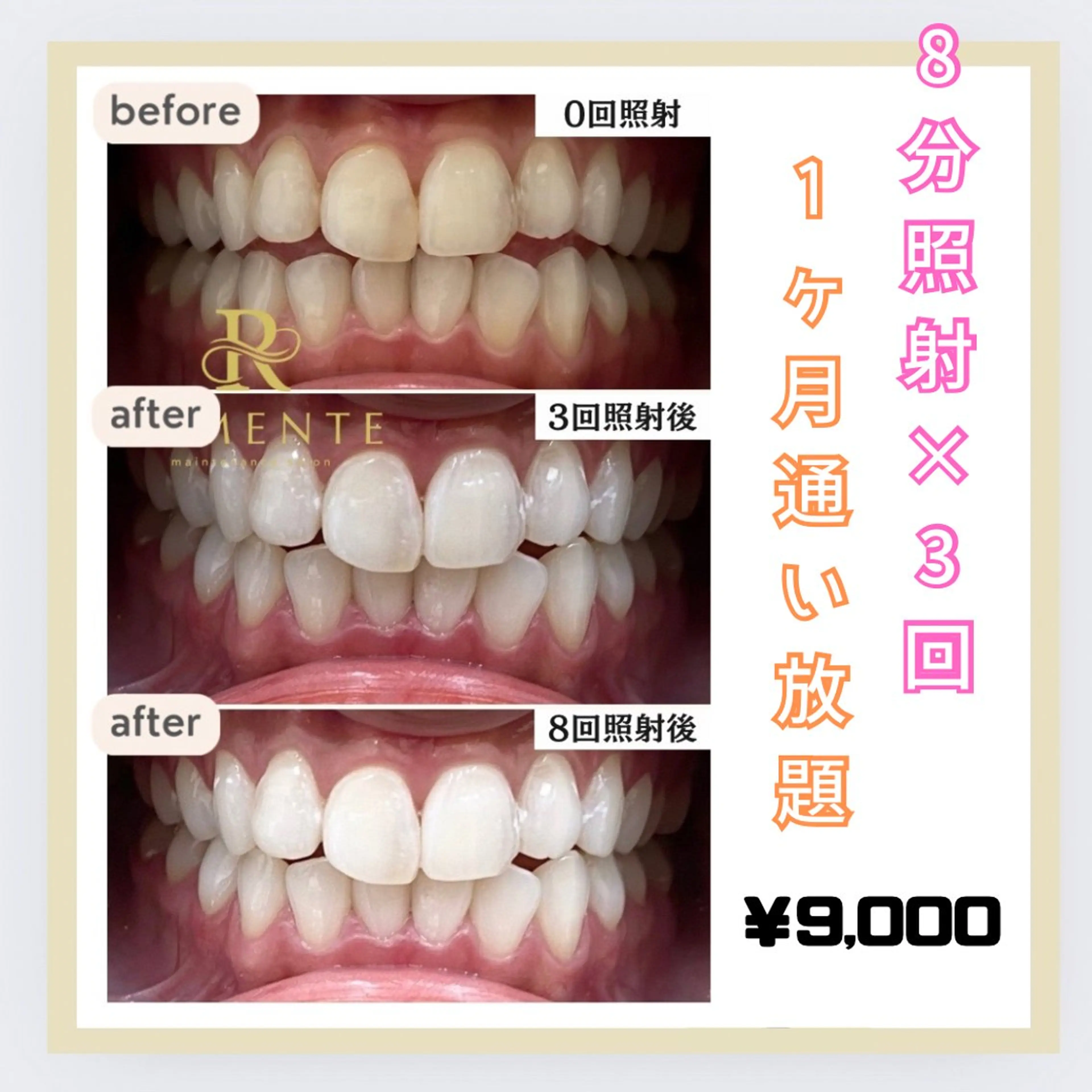 【１ヶ月通い放題・サブスク】セルフホワイトニング　¥9,000の写真