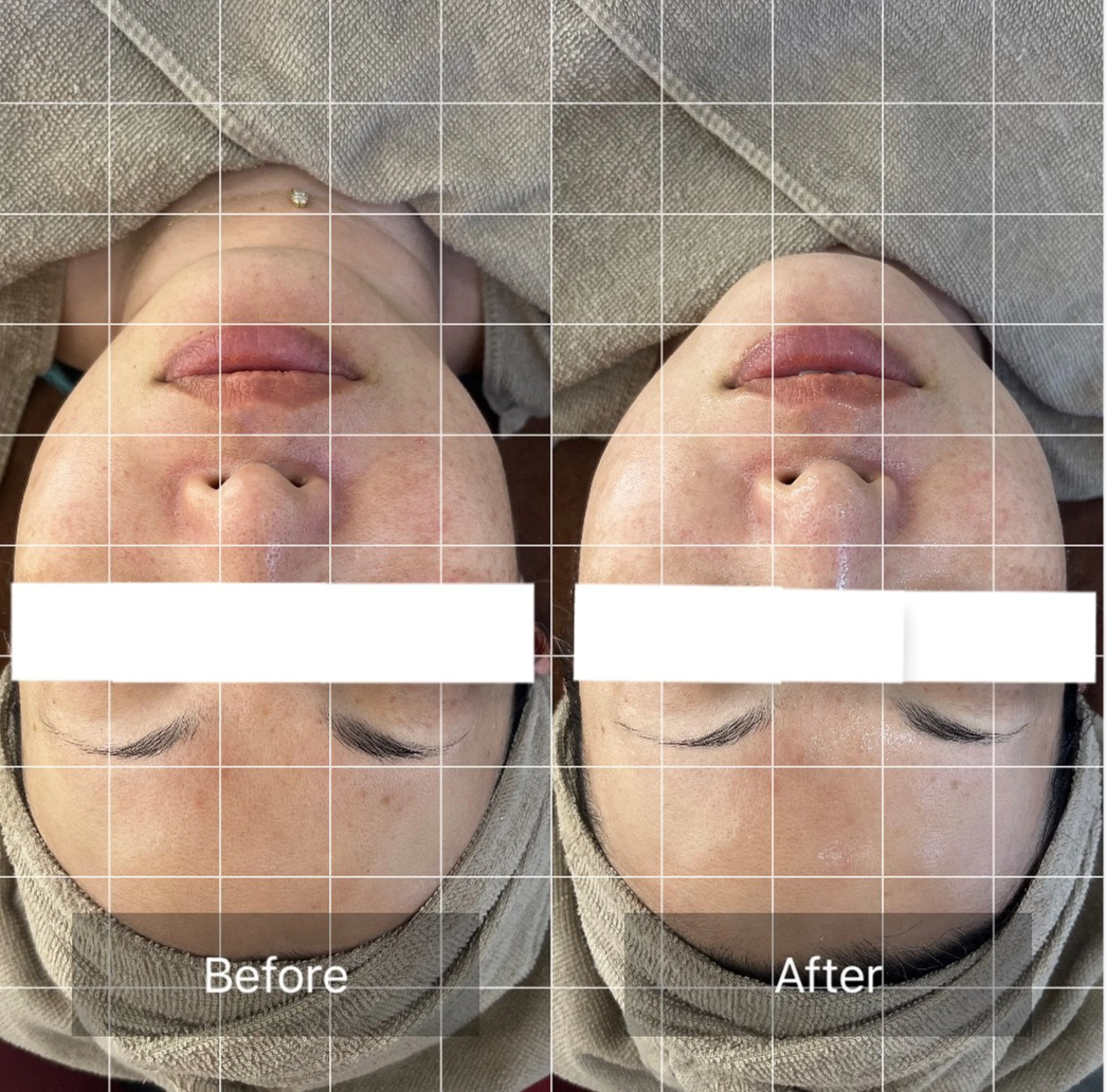 【エレクトロポレーション】顔のむくみ、たるみ、毛穴の開き、小顔、リフトアップしたい方！の写真
