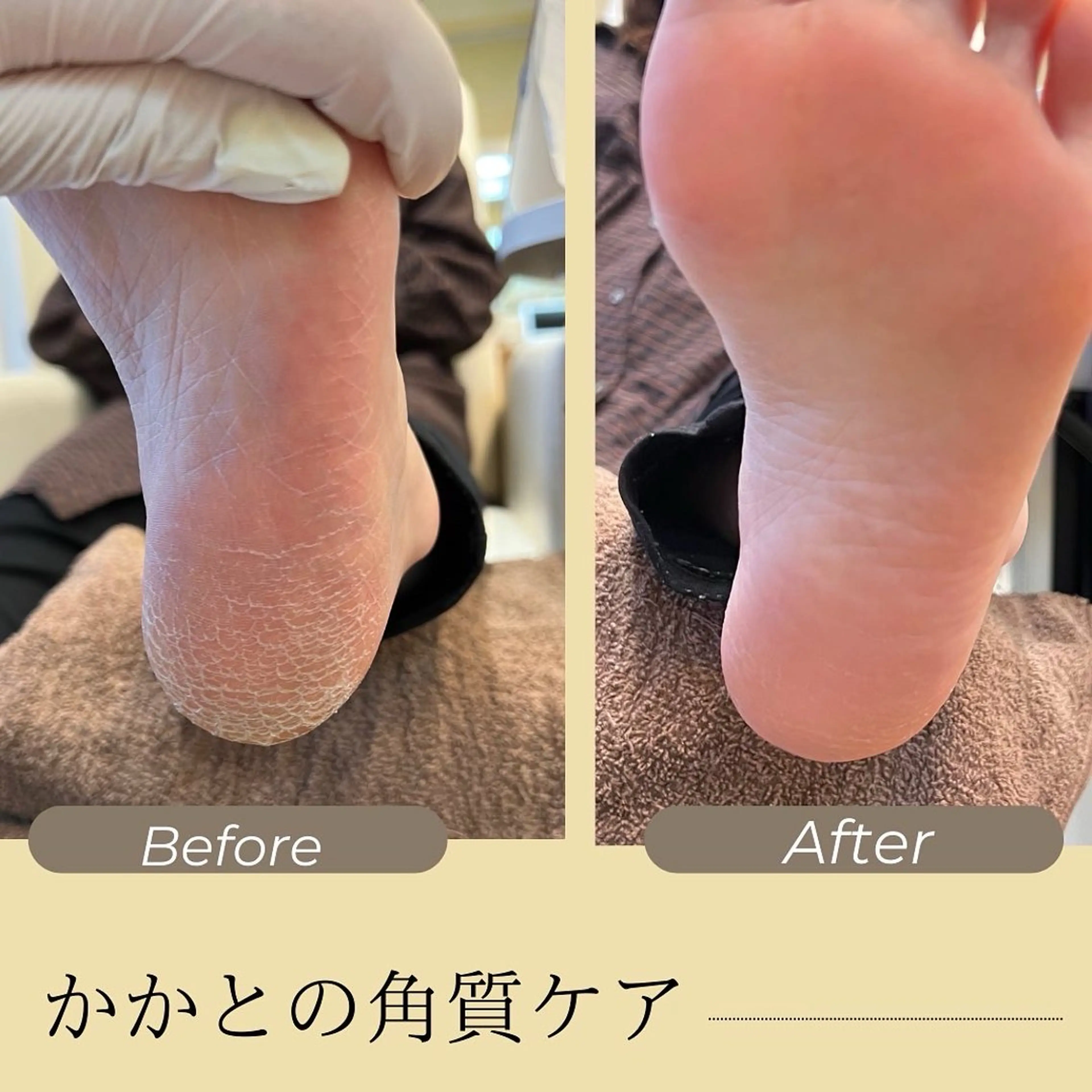 【フット】角質除去（1h）¥4500の写真
