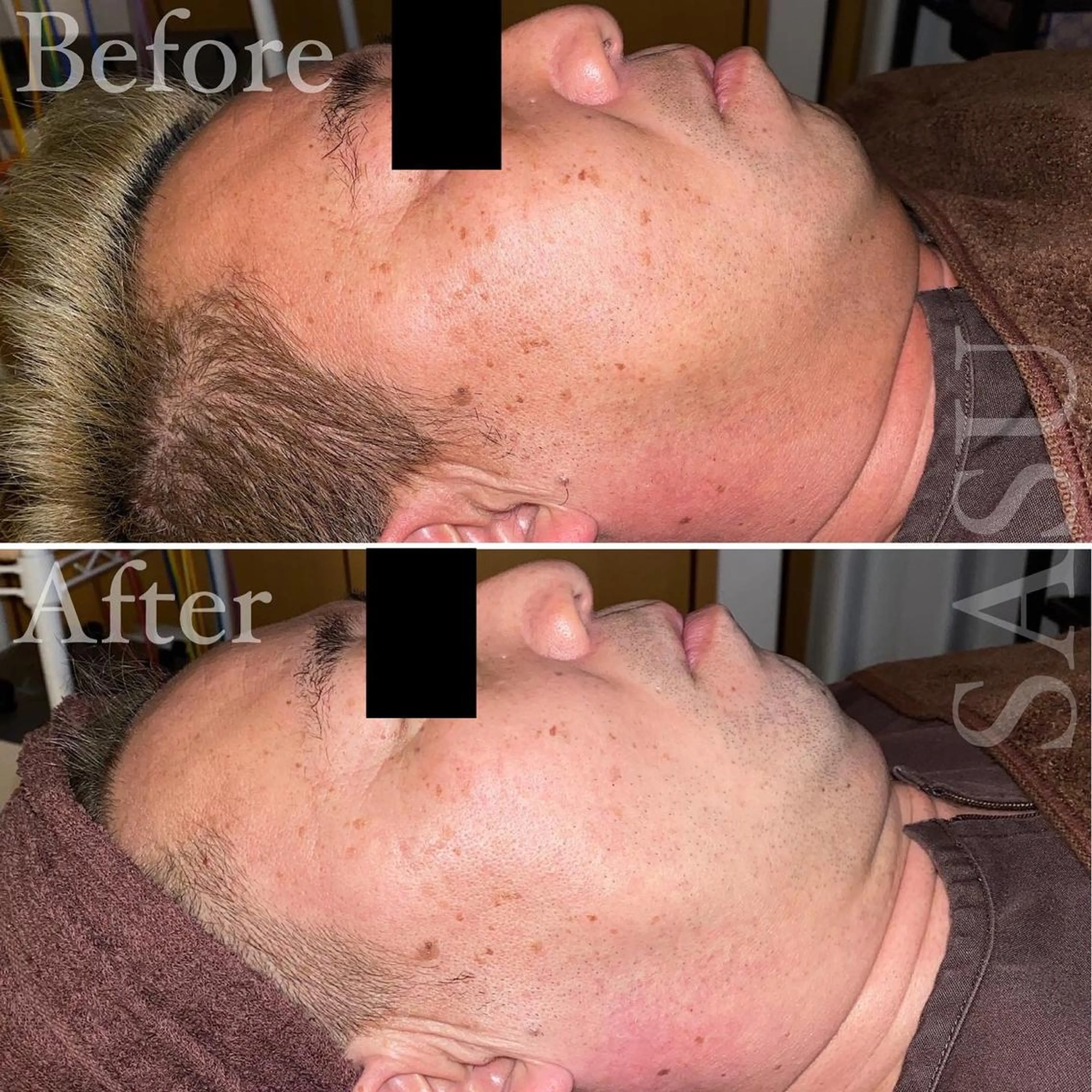 メンズ マツエク・マツパ アイブロウ 即小顔♥️美容鍼× ハーブピーリングのその他イメージ