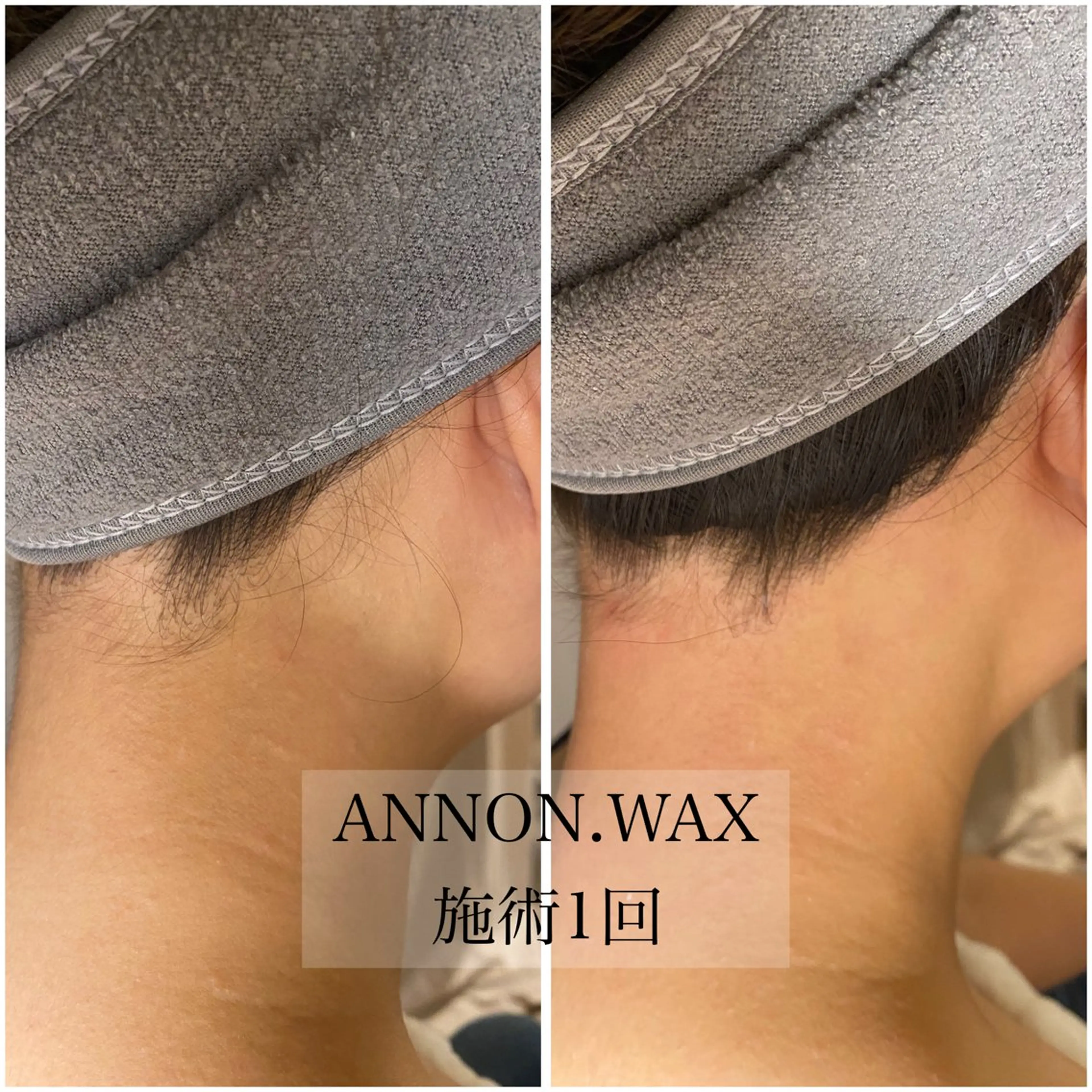 その他 肌質改善ワックス専門 yukiのエステ・リラクイメージ