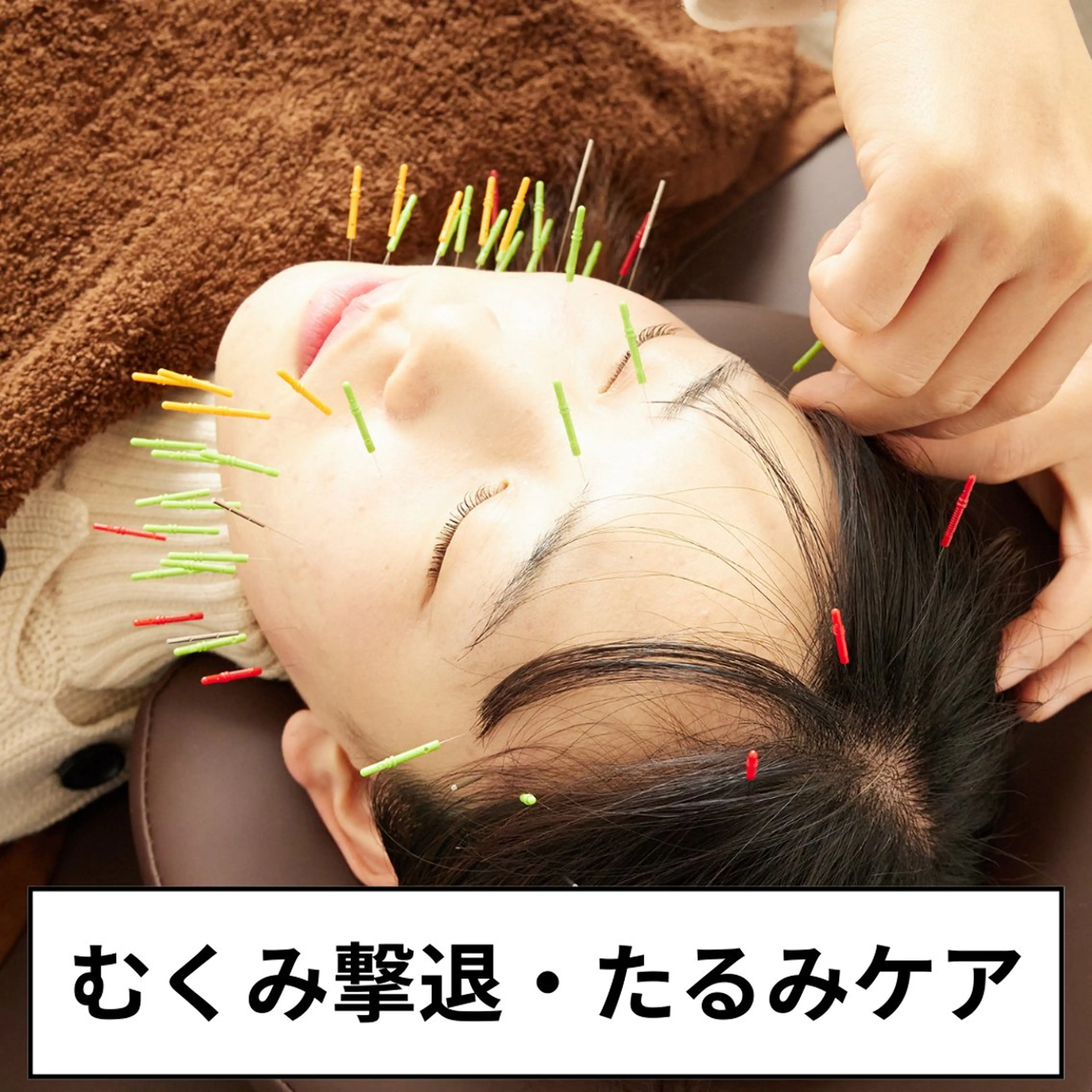 【9月限定☆小顔美容鍼】むくみ撃退＆たるみケア&歯ぎしり　¥10000→¥3980の写真