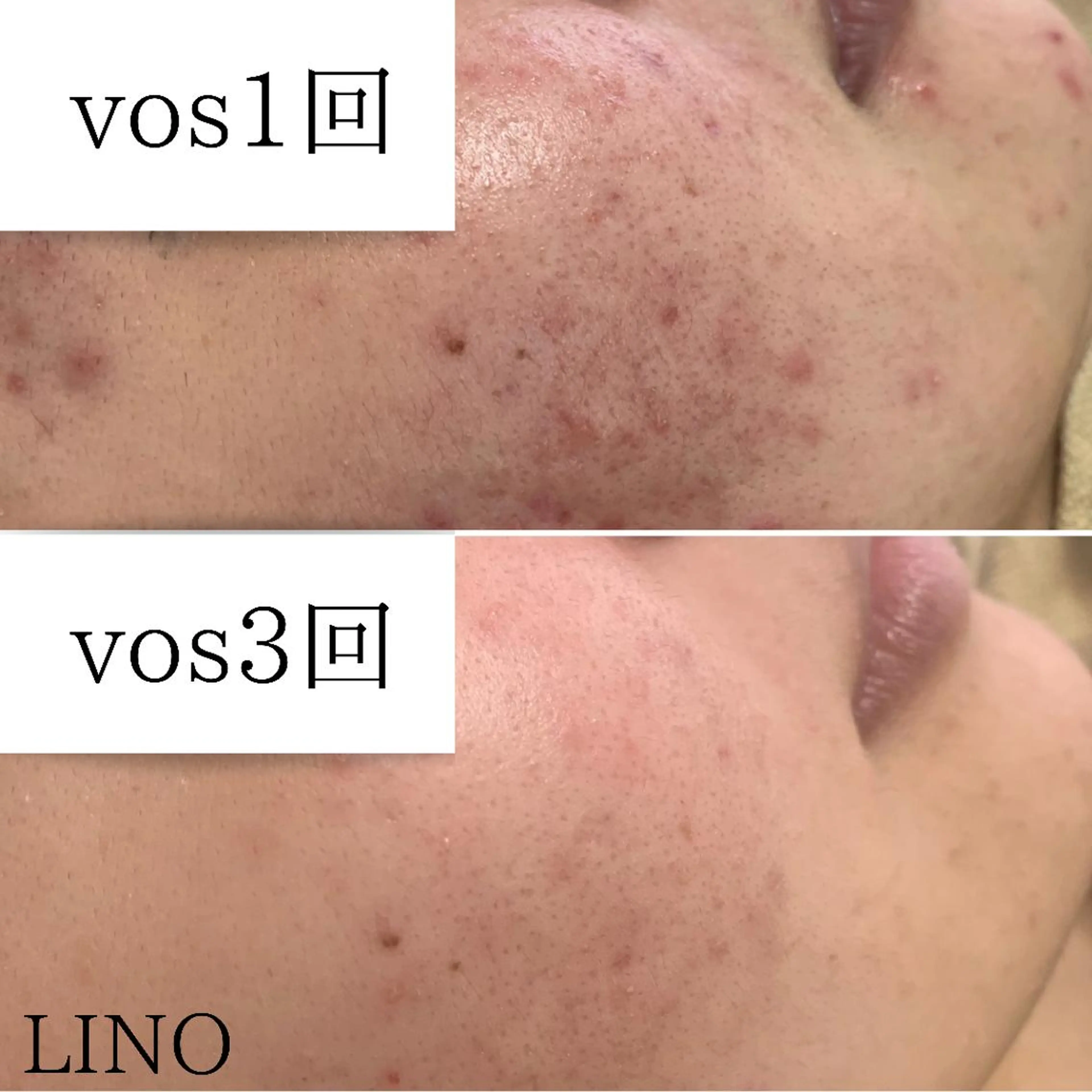 beautysalon  LINO所属・7月限定【平日限定】 全メニュ¥4,400のエステ・リラクイメージ