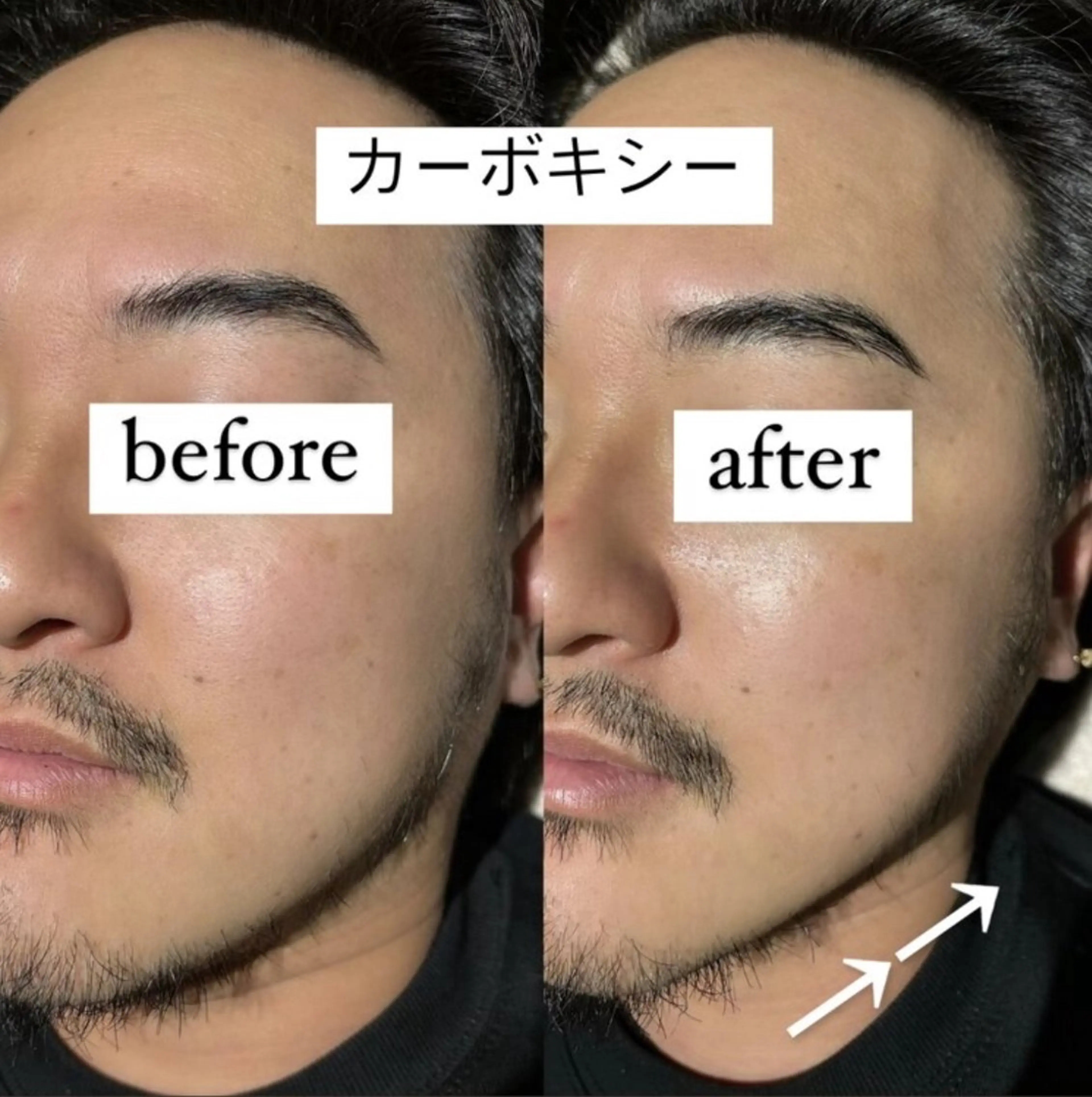 【リフトアップ】カーボキシーパックの写真
