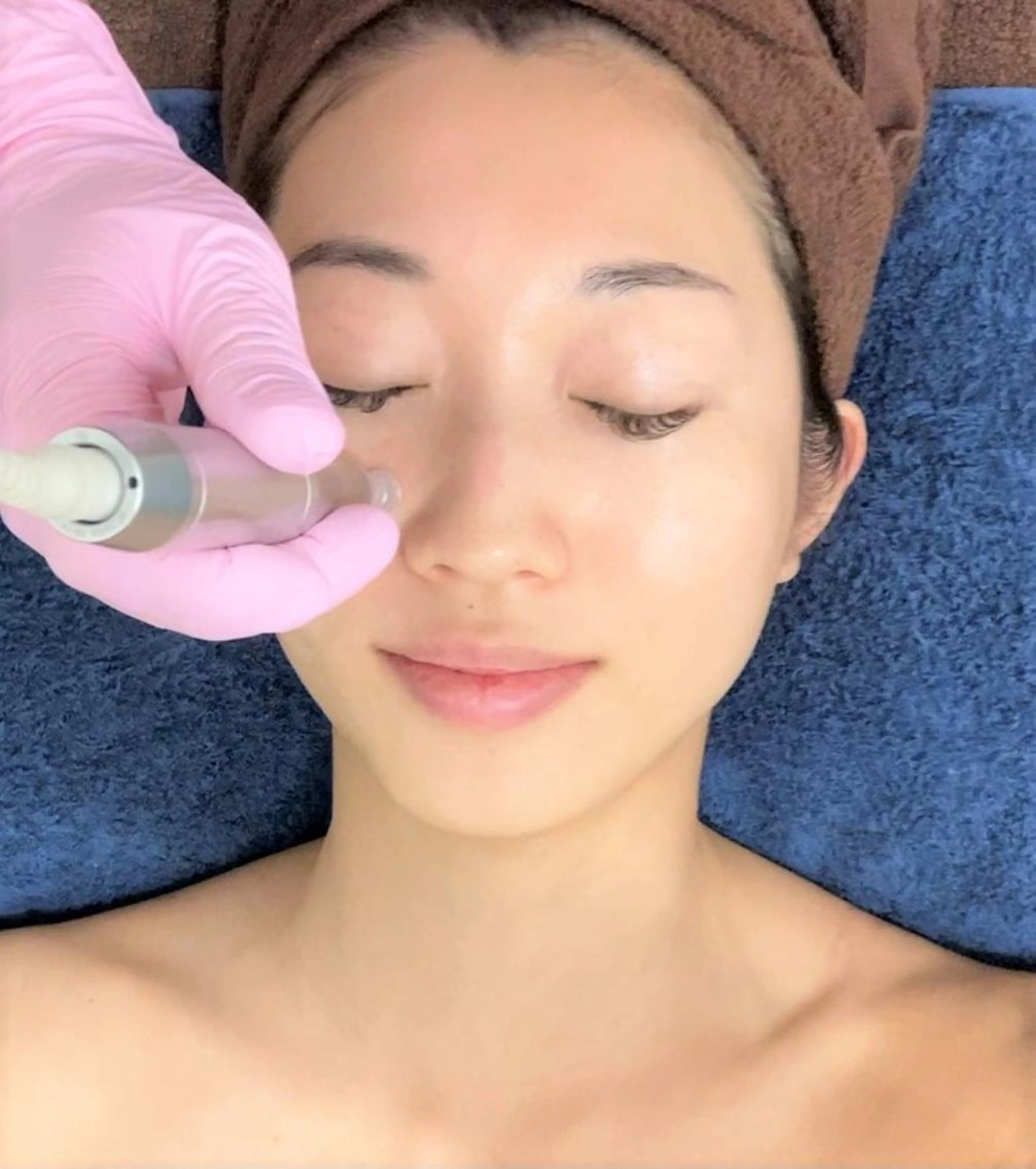 【ミニモ学割＆30歳以下限定】エステ版ダーマペン！美容液・パック込の写真