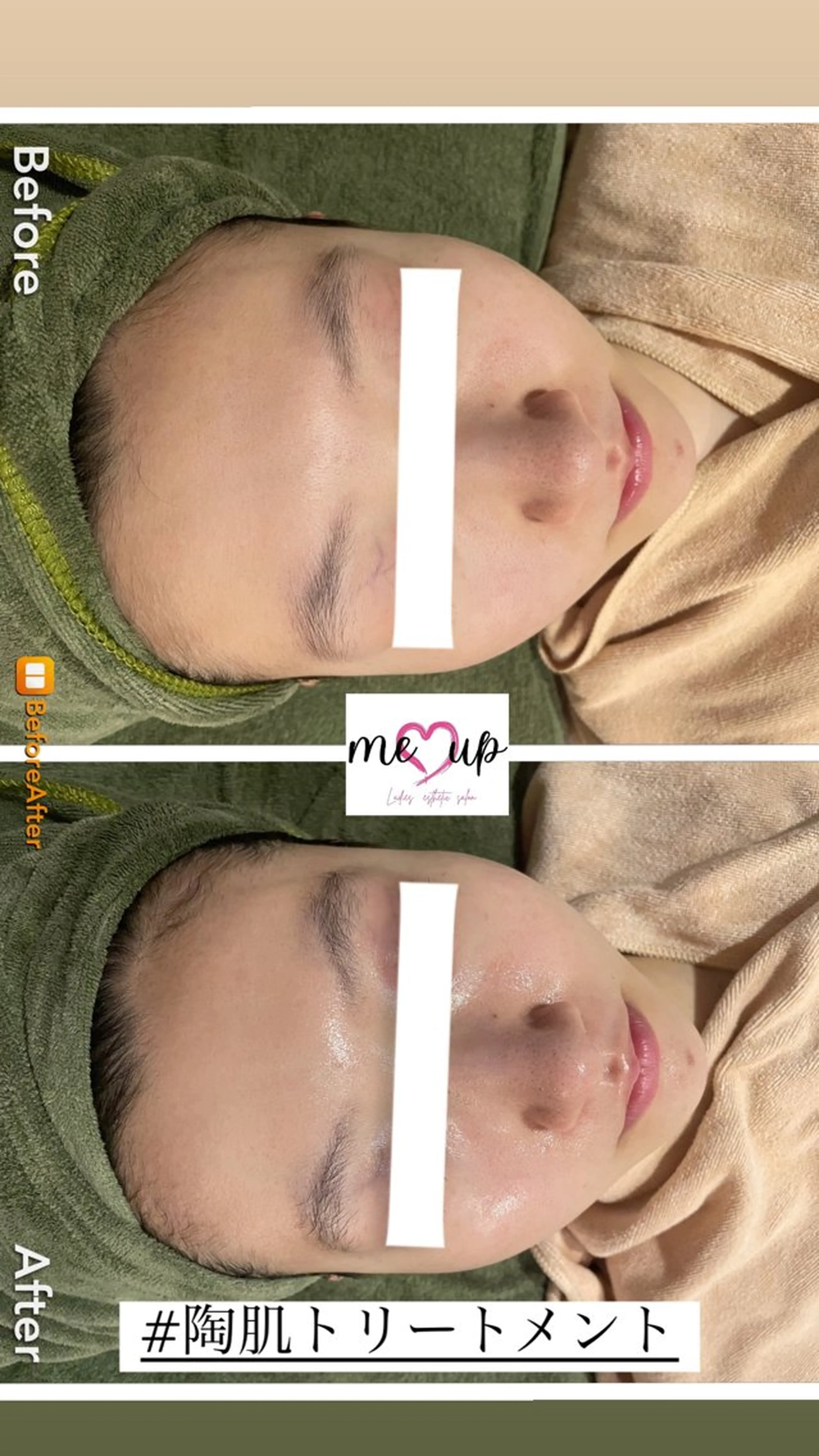 エステ Meupニキビ専門店 背中/ハーブ/ララのその他イメージ