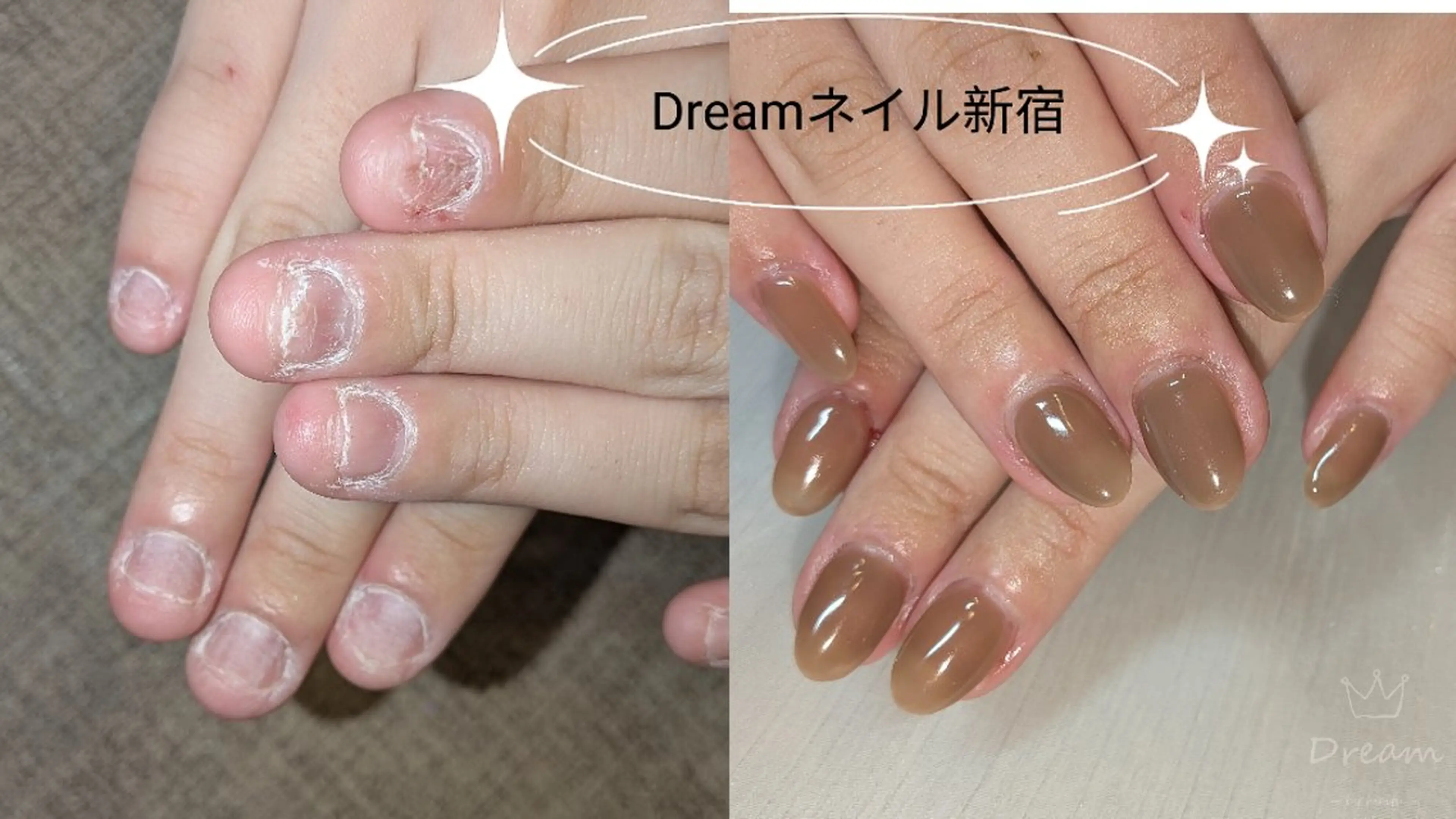 ネイル ハンドネイル ハンドケア ネイリストゆか💅 長さだし、深爪矯正のネイルデザイン