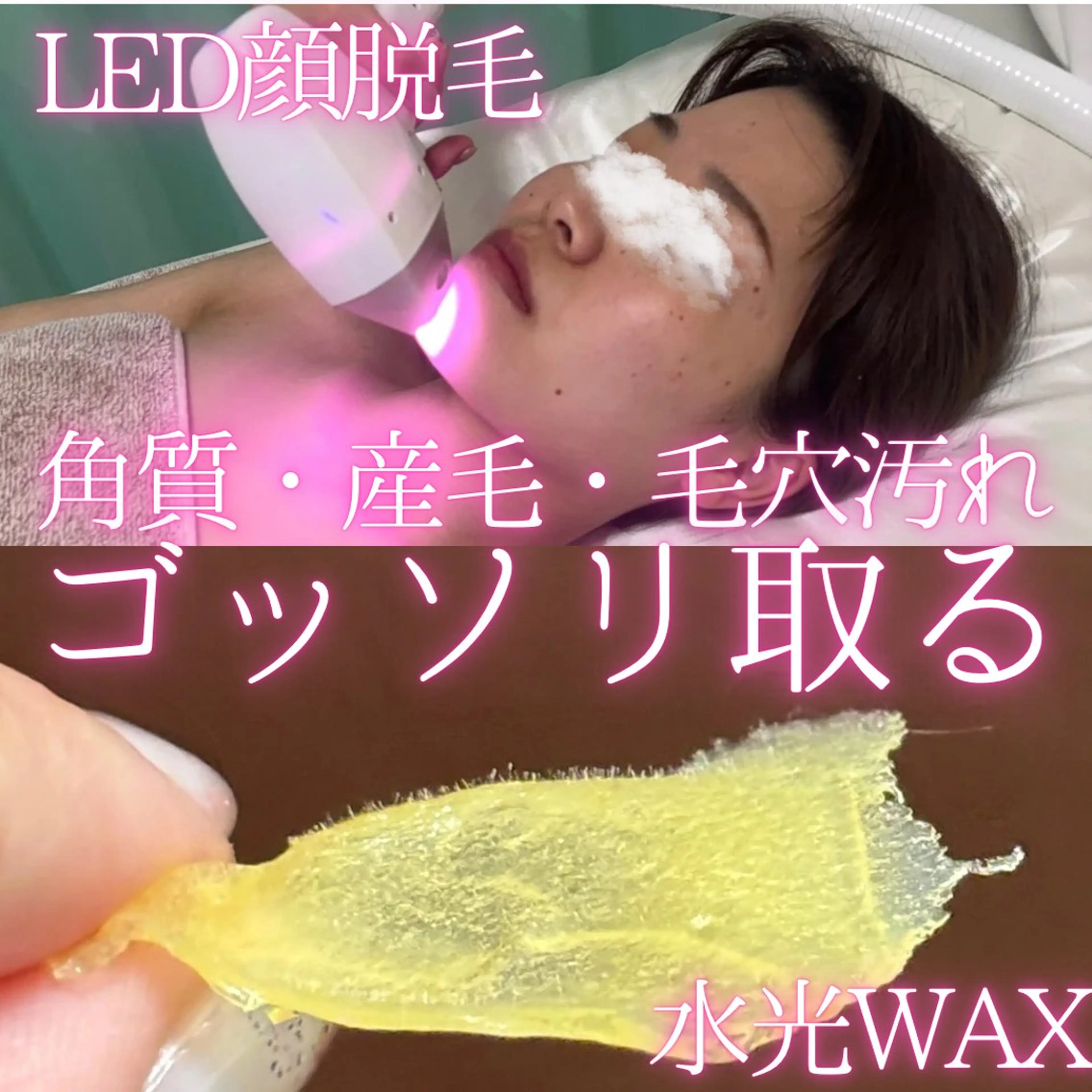 【ハイブリッド脱毛】マツヤニ水光WAX+顔LED脱毛✨産毛・毛穴汚れ・角質をごっそりケア！もちもちで透明感あるお肌に🩷の写真