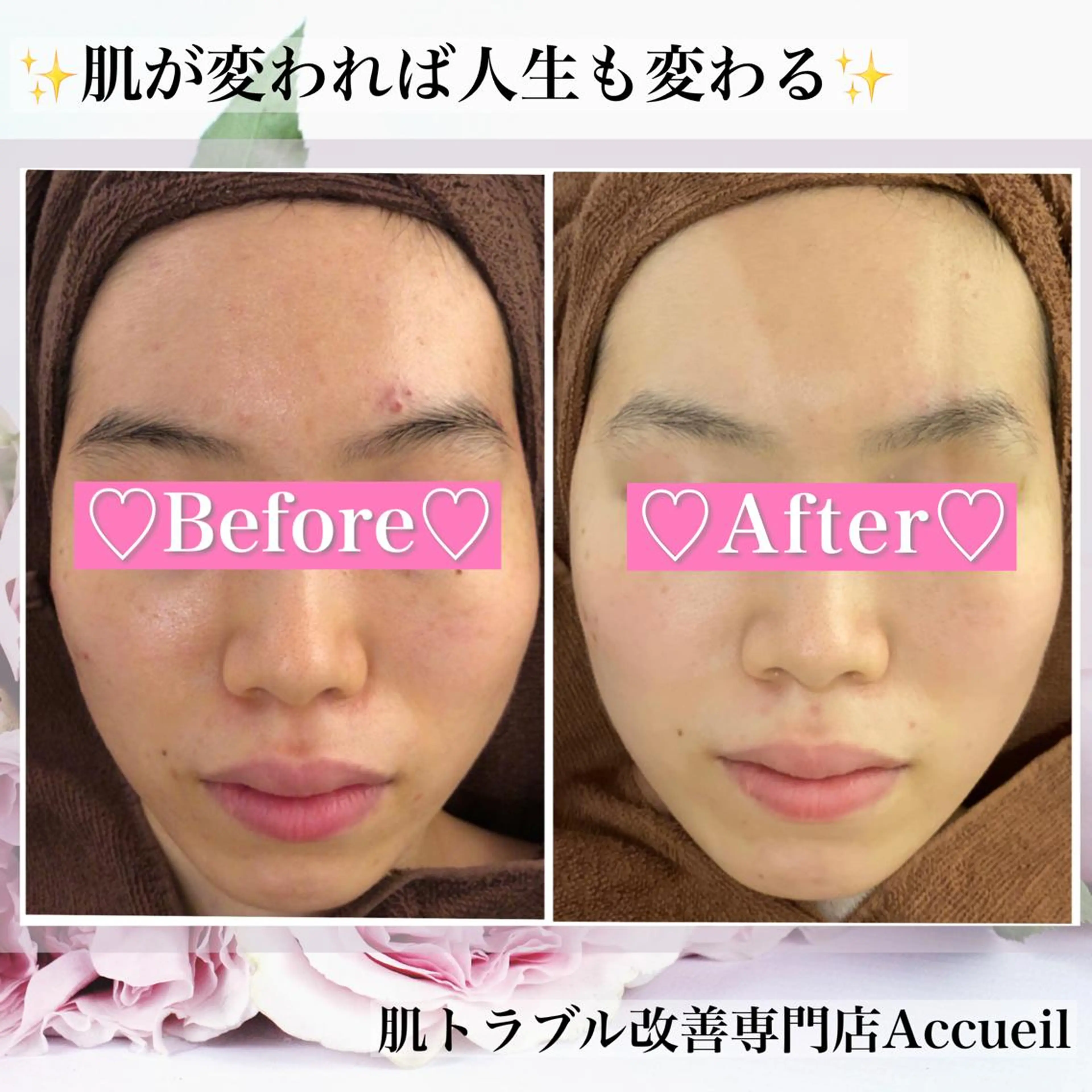 ミディアム カラー パーマ ヘアアレンジ メンズ キッズ ネイル マツエク・マツパ アイブロウ エステ リラク アクール　齋藤 ♡肌トラブル卒業のエステ・リラクイメージ