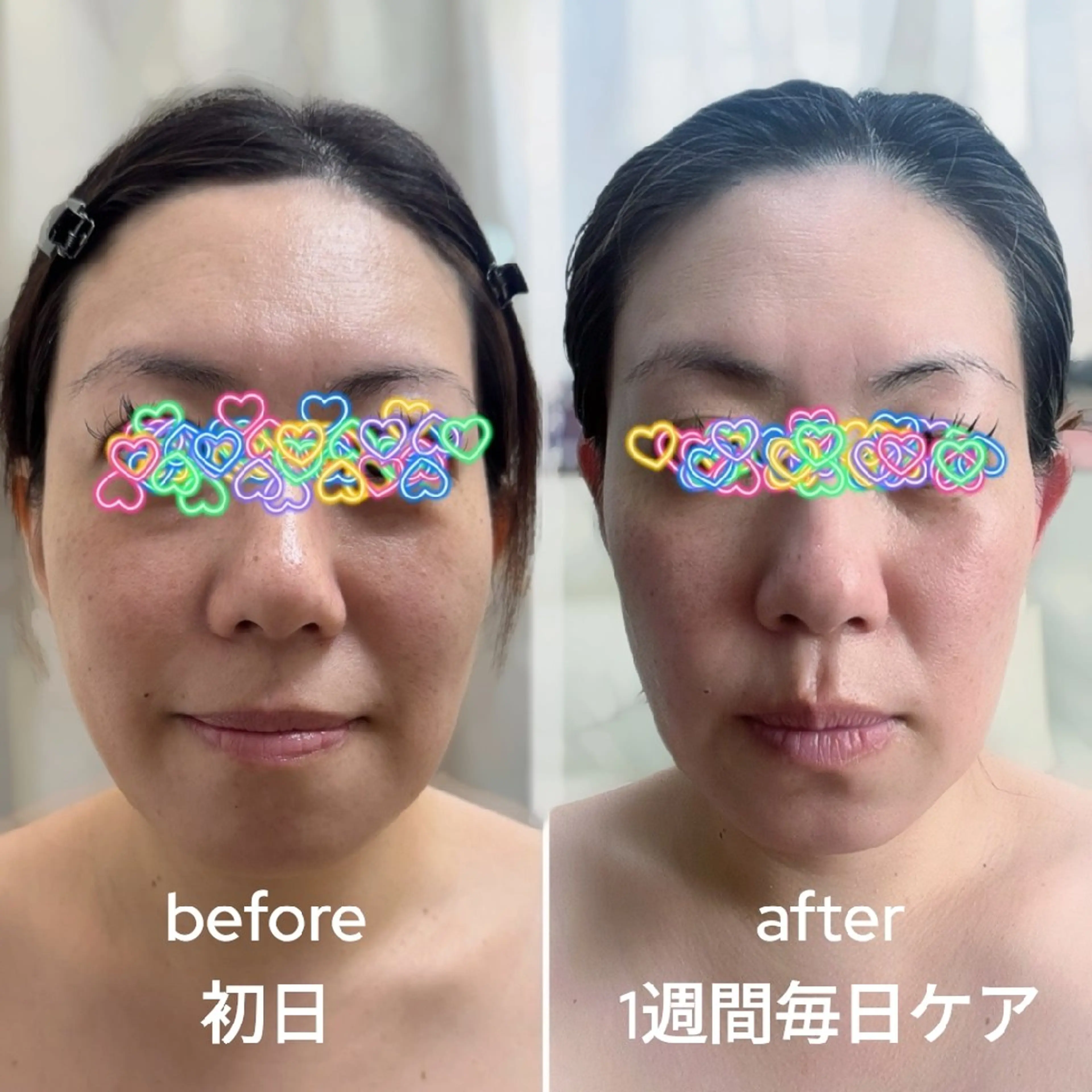 【小顔補正/頭皮マッサージ/バブルパック】ヒト幹細胞！浮腫みたるみ改善９０分の写真