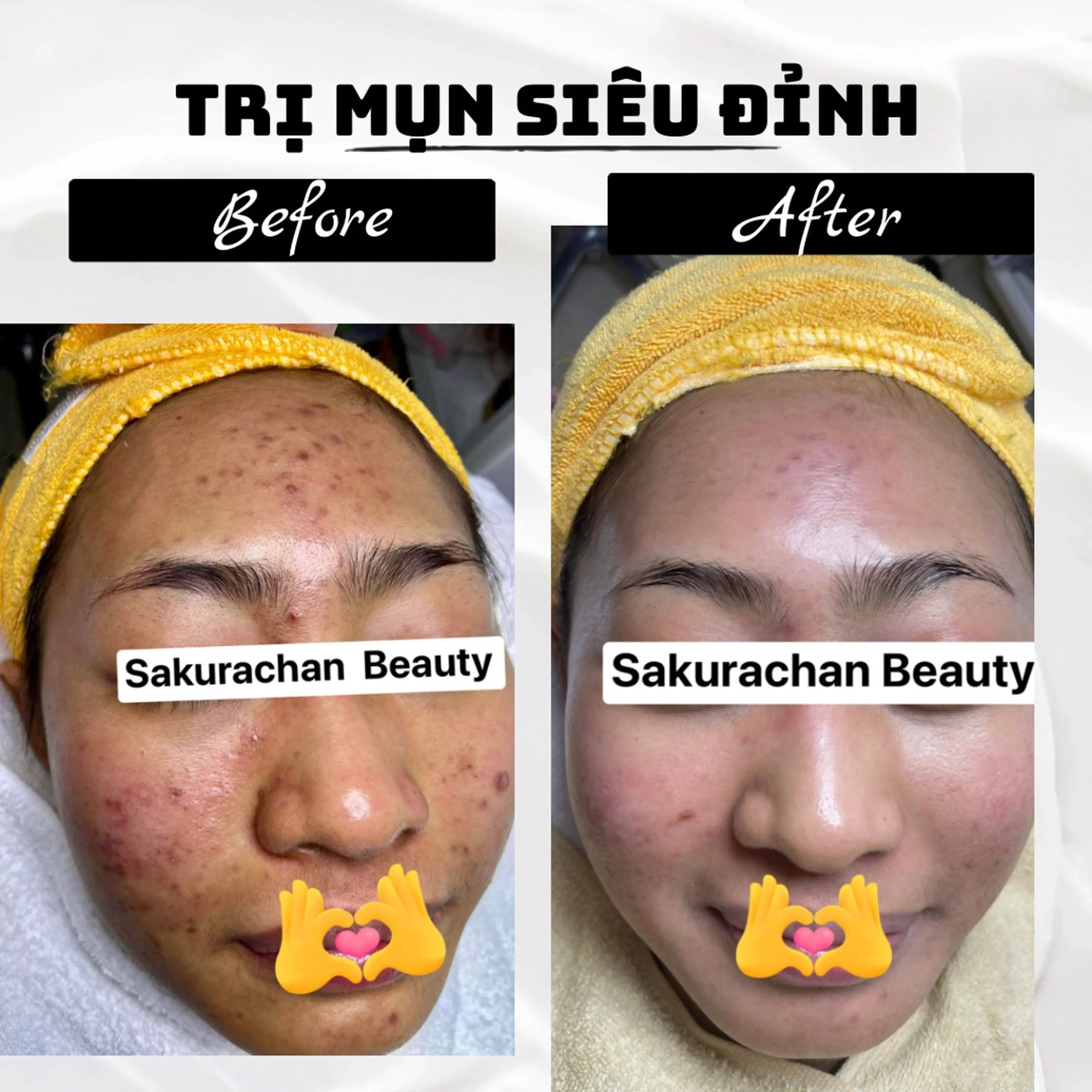 エステ ニキビ、痩身、脱毛、 サクラチャンスパのエステ・リラクイメージ