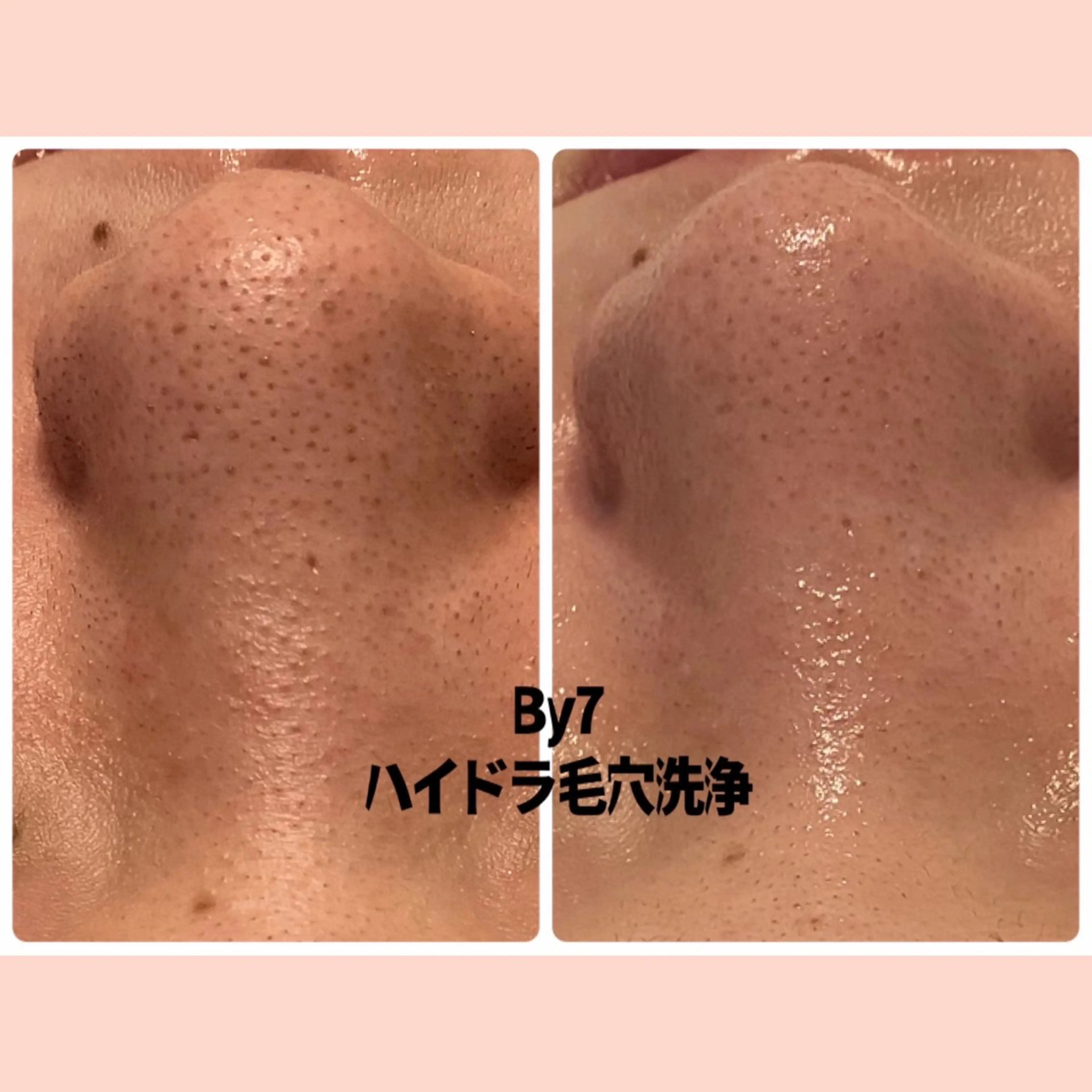女性限定👩機械導入記念価格🎉毛穴気になる方必須❣️プラズマ＋ハイドラ毛穴洗浄×ピーリングの写真