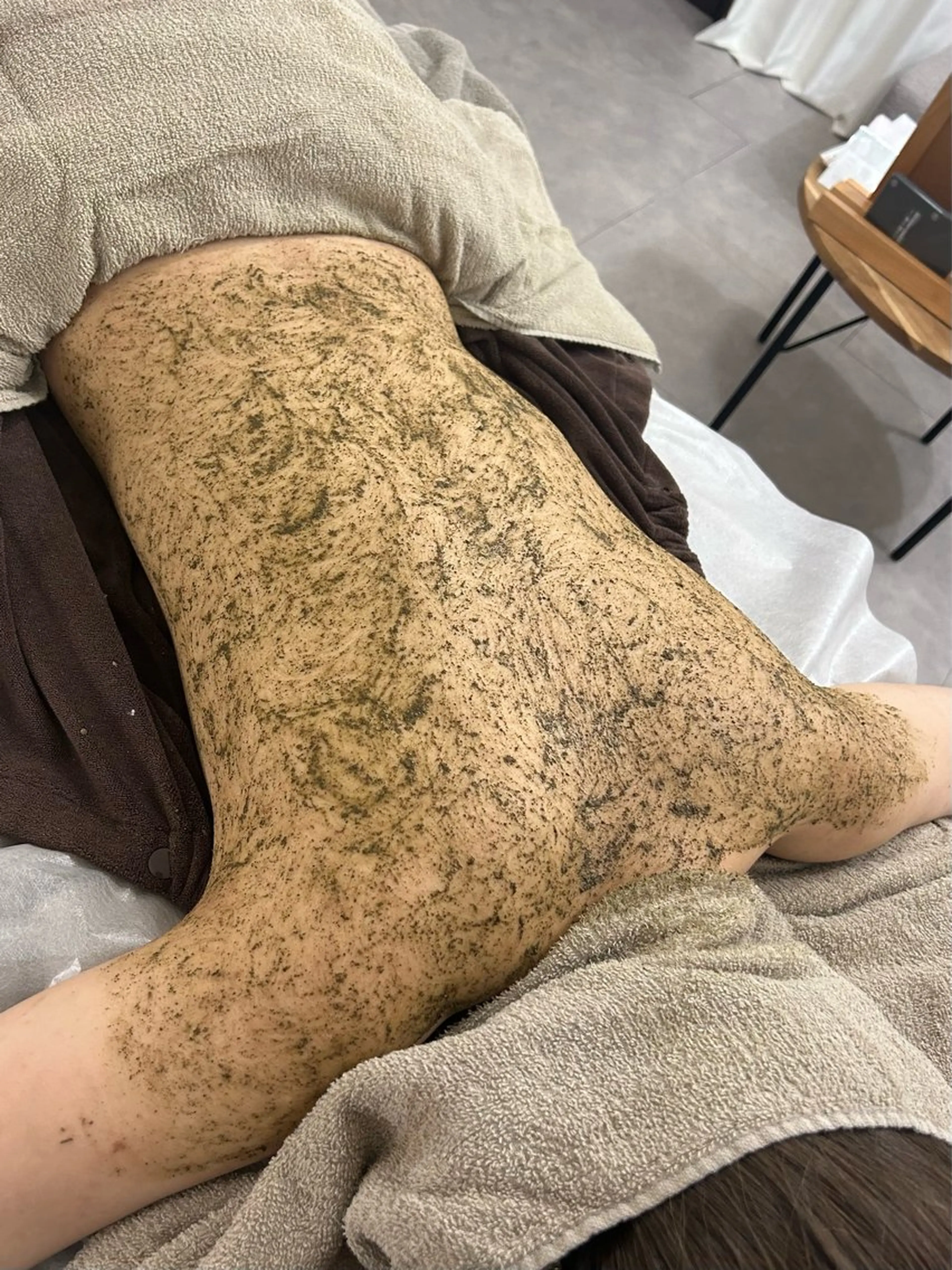 【平日限定⭐️ニキビケアでお悩みの方のみ】背中REVIハーブピーリング（全体）の写真