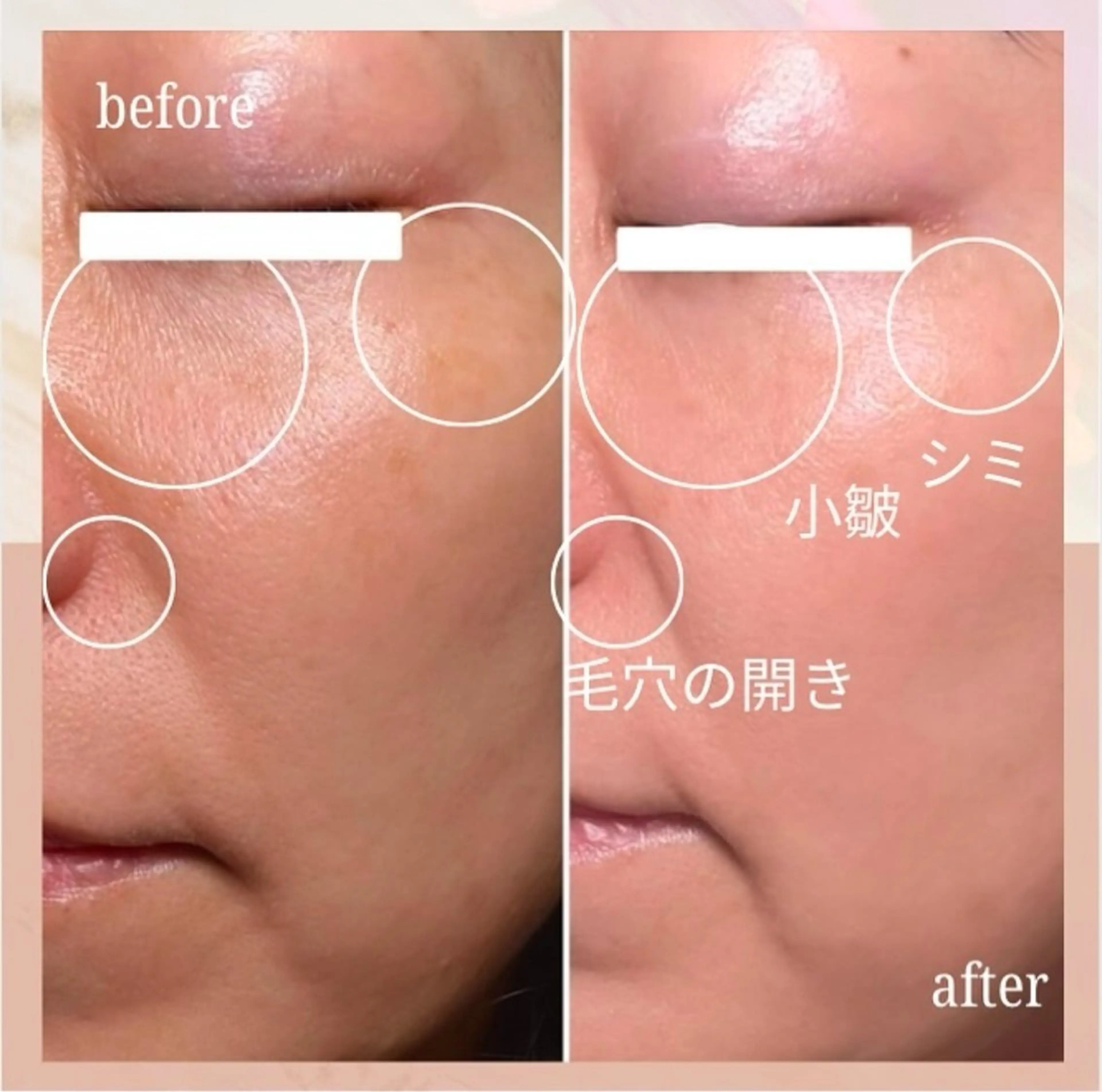 ♡アクアダーマ✖️ 100%原液エクソソーム♡で肌の悩みオールマイティーに解決！【毛穴/肌荒れ/シワ】✨💎の写真