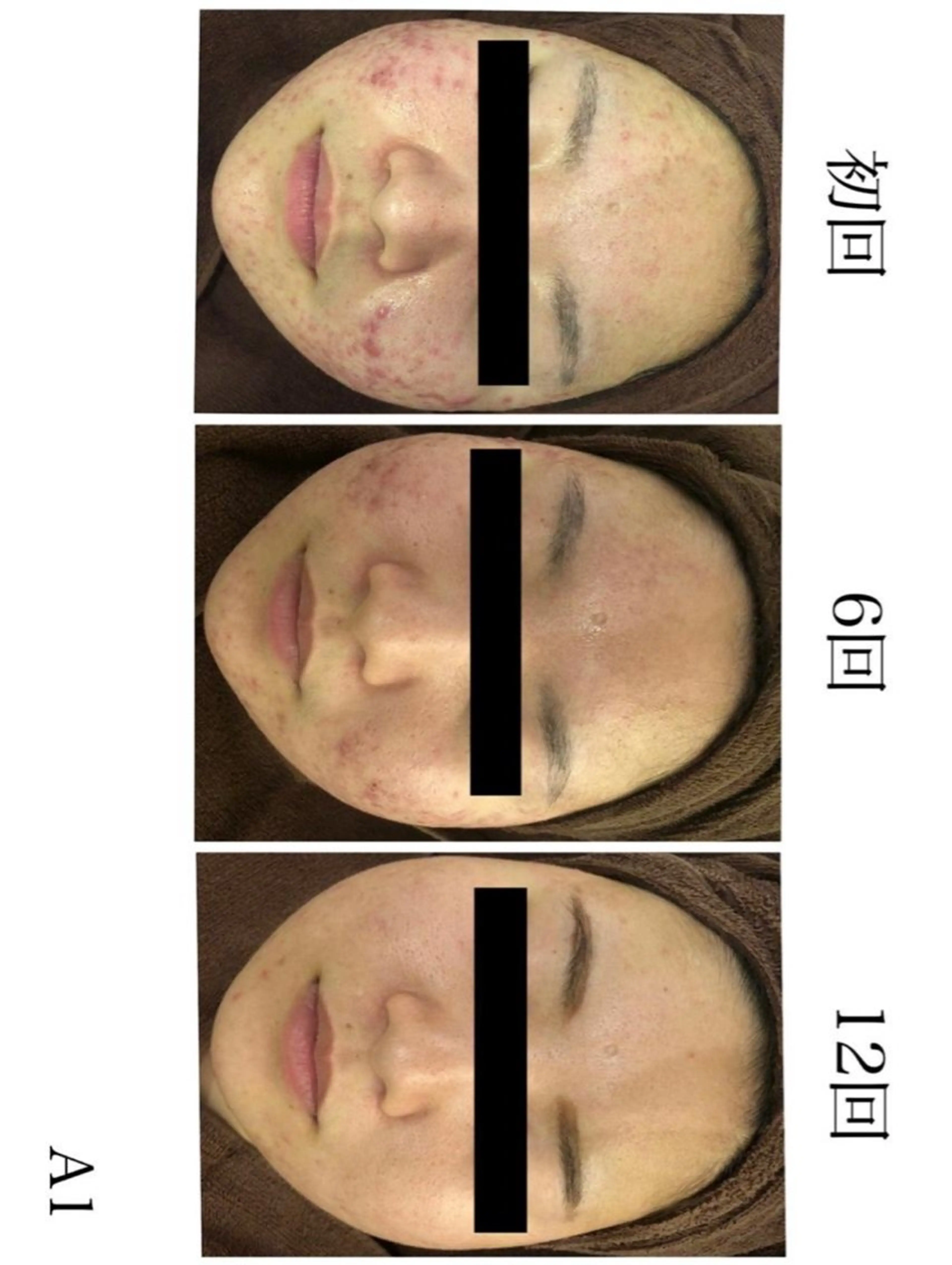 学生ニキビ改善🍀 優しい肌質改善のエステ・リラクイメージ