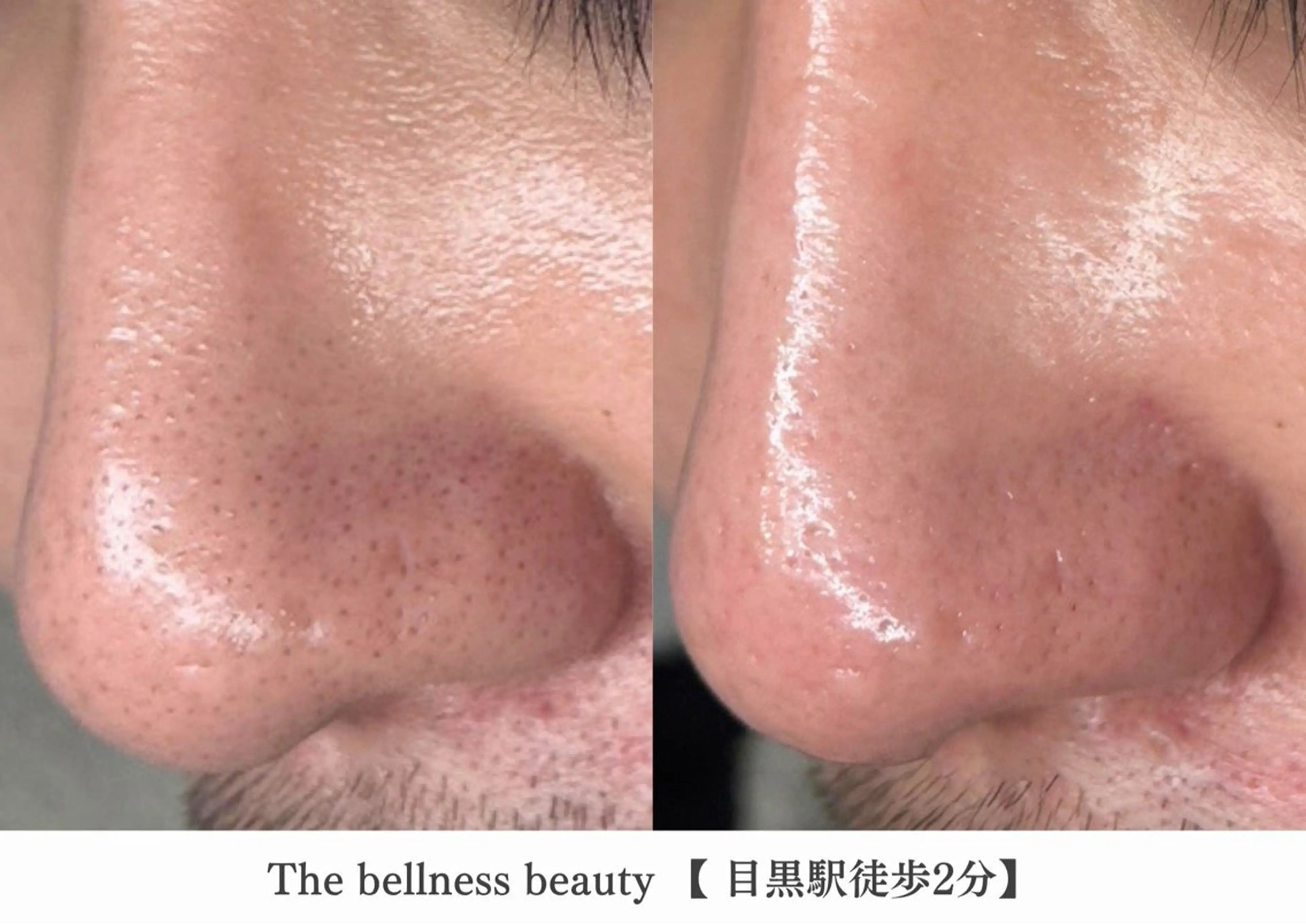 エステ 《毛穴レス美肌》ザ・ ベルネス 目黒駅2分のエステ・リラクイメージ