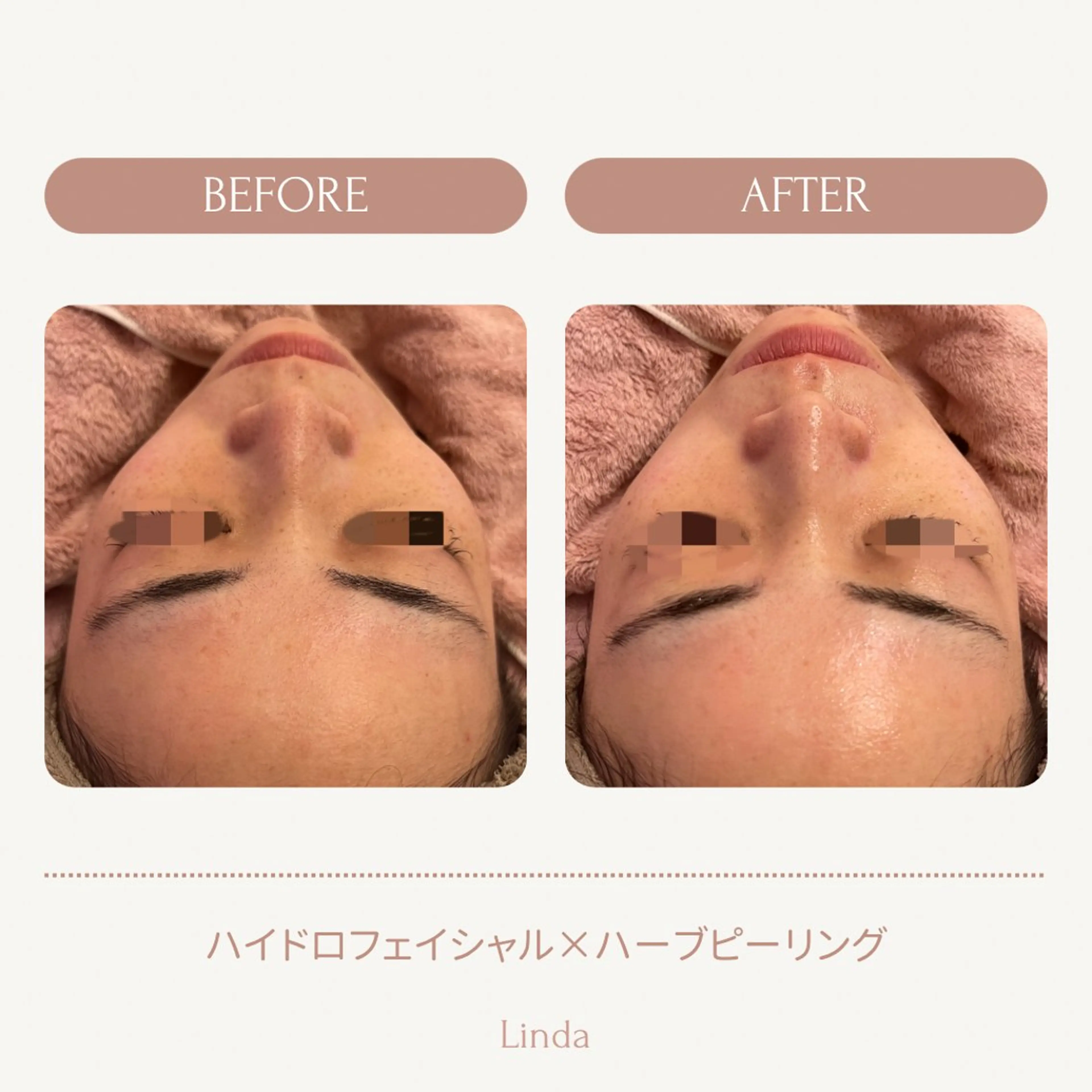エステ アイラッシュ&エステサロンLinda西宮所属・小顔&肌質改善 LINDA西宮 AIのエステ・リラクイメージ