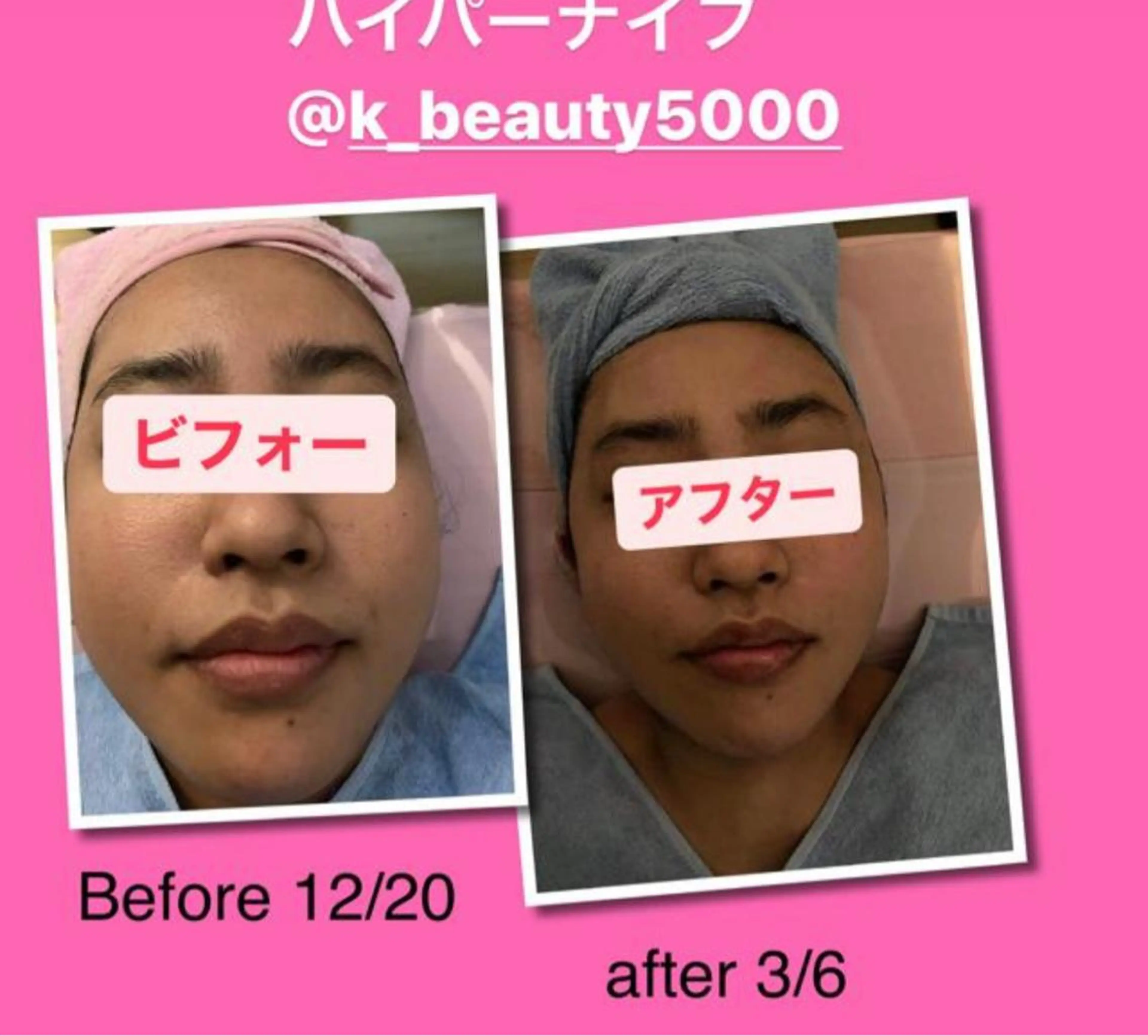 エステ リラク 【ハイパーナイフ痩身&小顔コルギ&ハーブピーリング】K-Beauty　東新宿所属・kーbeauty小顔 コルギ&インディバのエステ・リラクイメージ