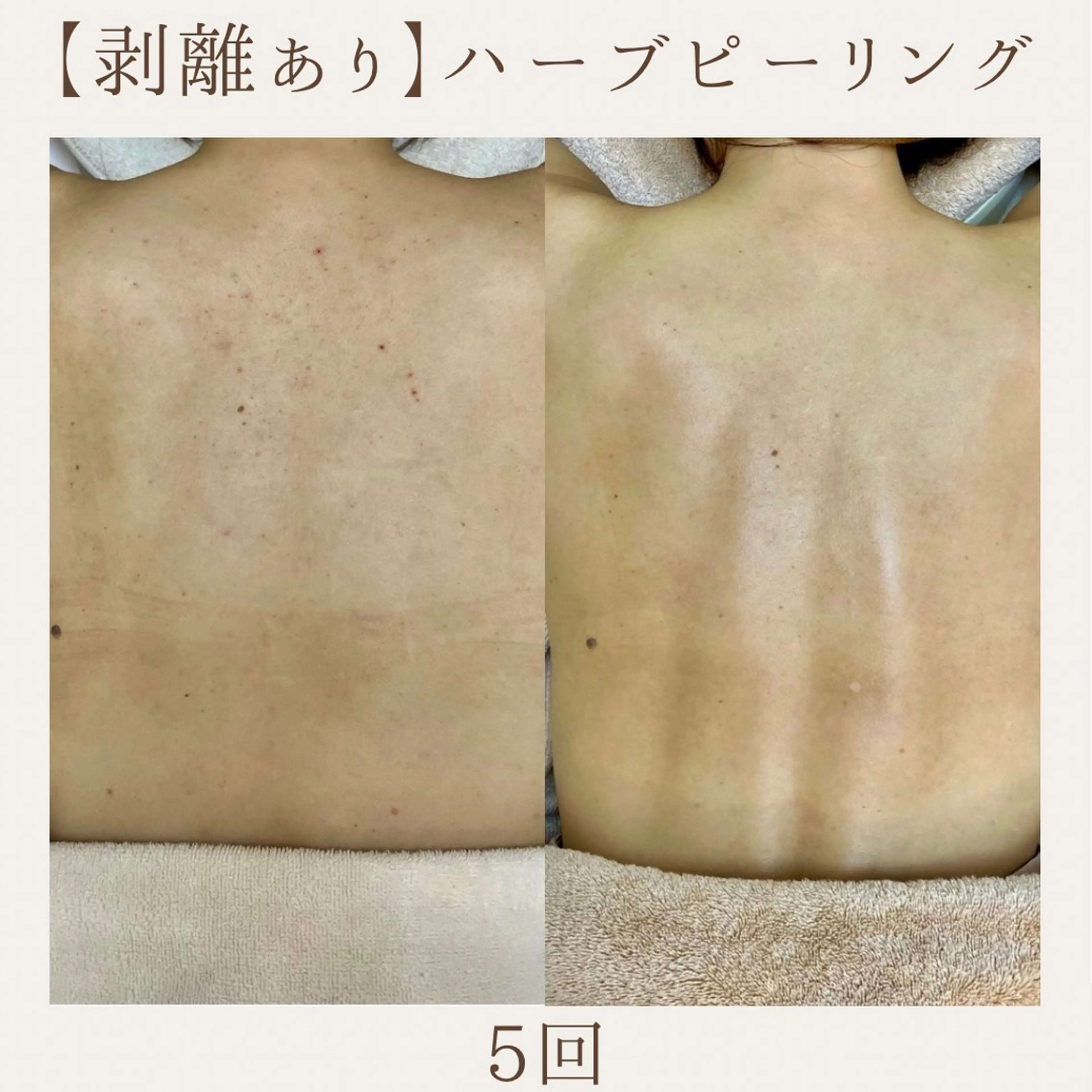 エステ 肌質改善サロン renew所属・肌質改善サロン renew/ｳｴｷのエステ・リラクイメージ