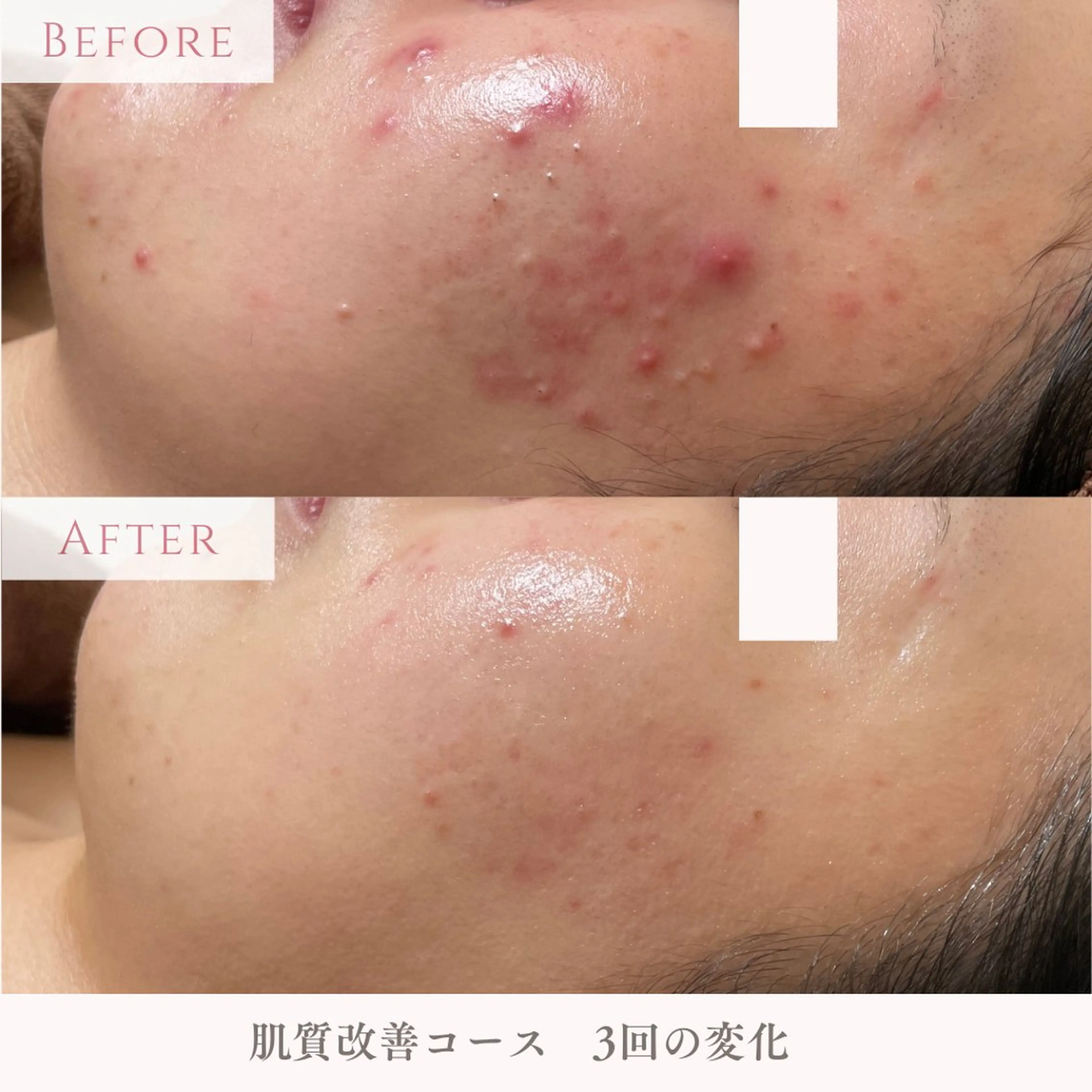 【毎月先着3名様限定！ 】繰り返すニキビ・ニキビ跡でお悩みの方へ✨肌質改善コース マッサージ付70分の写真
