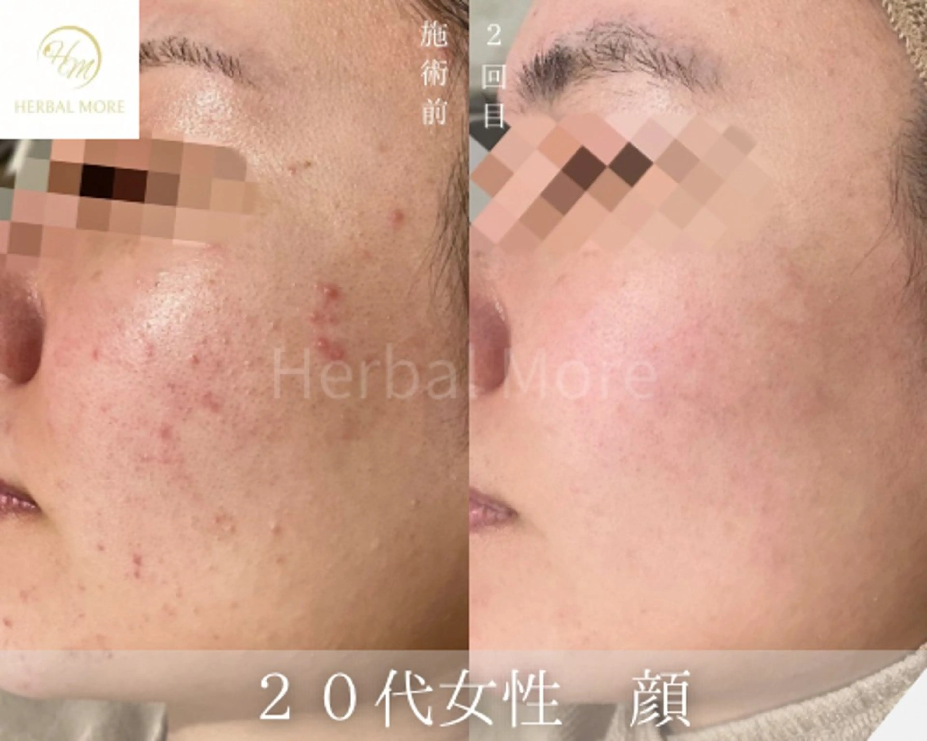 【平日10時​〜​15時限定】顔用/剥けない幹細胞ハーブピーリングの写真