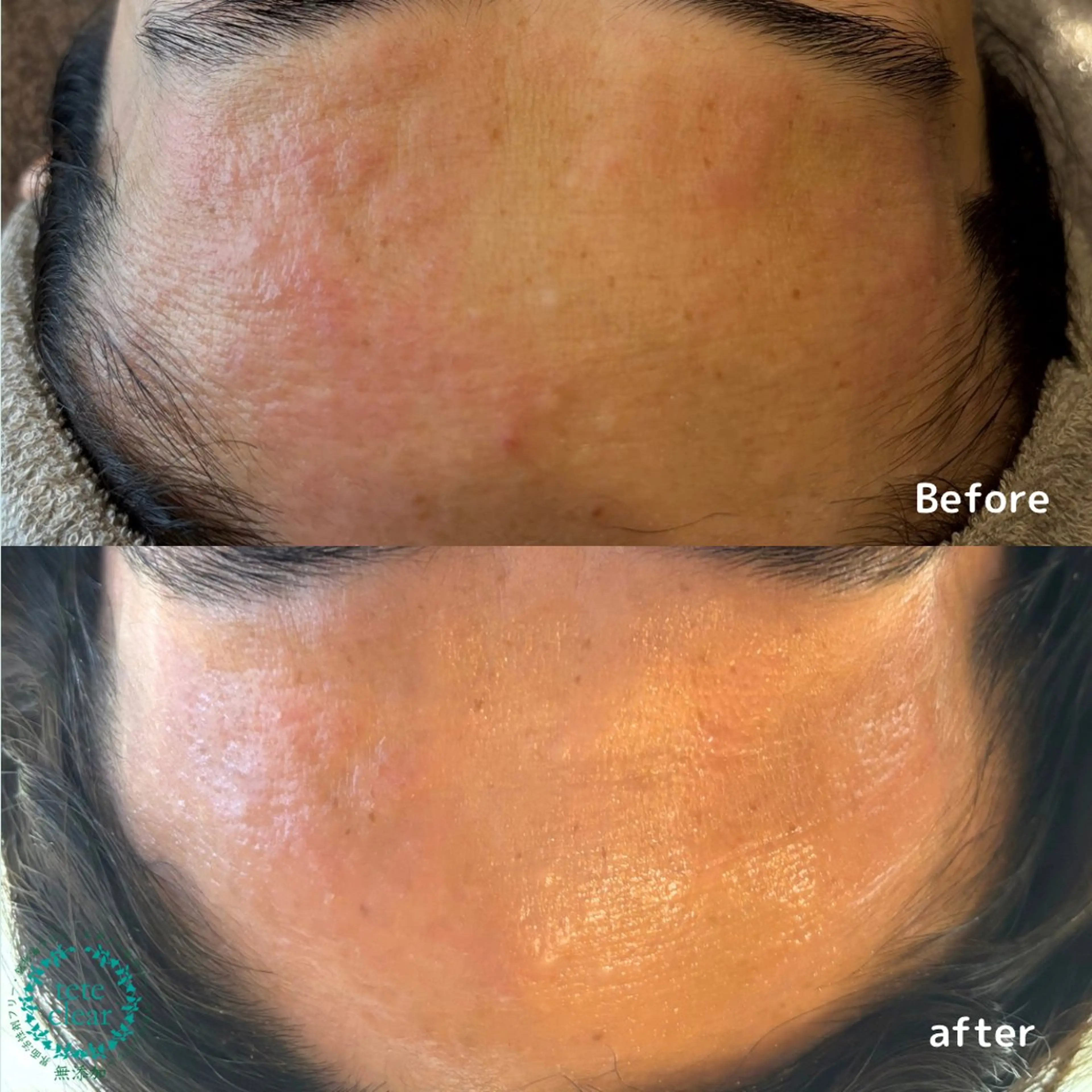 美肌コースの写真