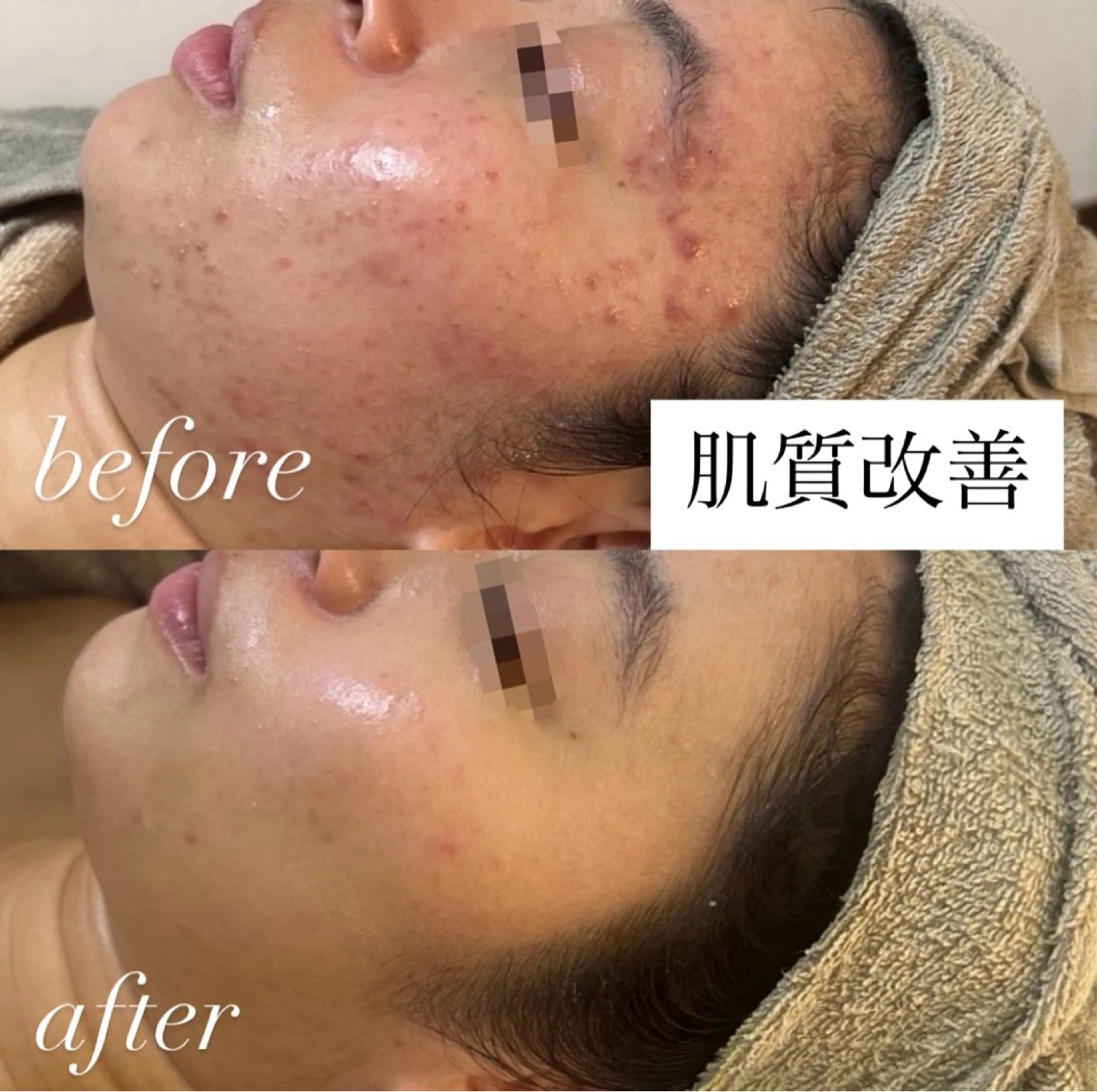 肌質改善専門サロンAte国分寺店所属・Ate Rikaのエステ・リラクイメージ