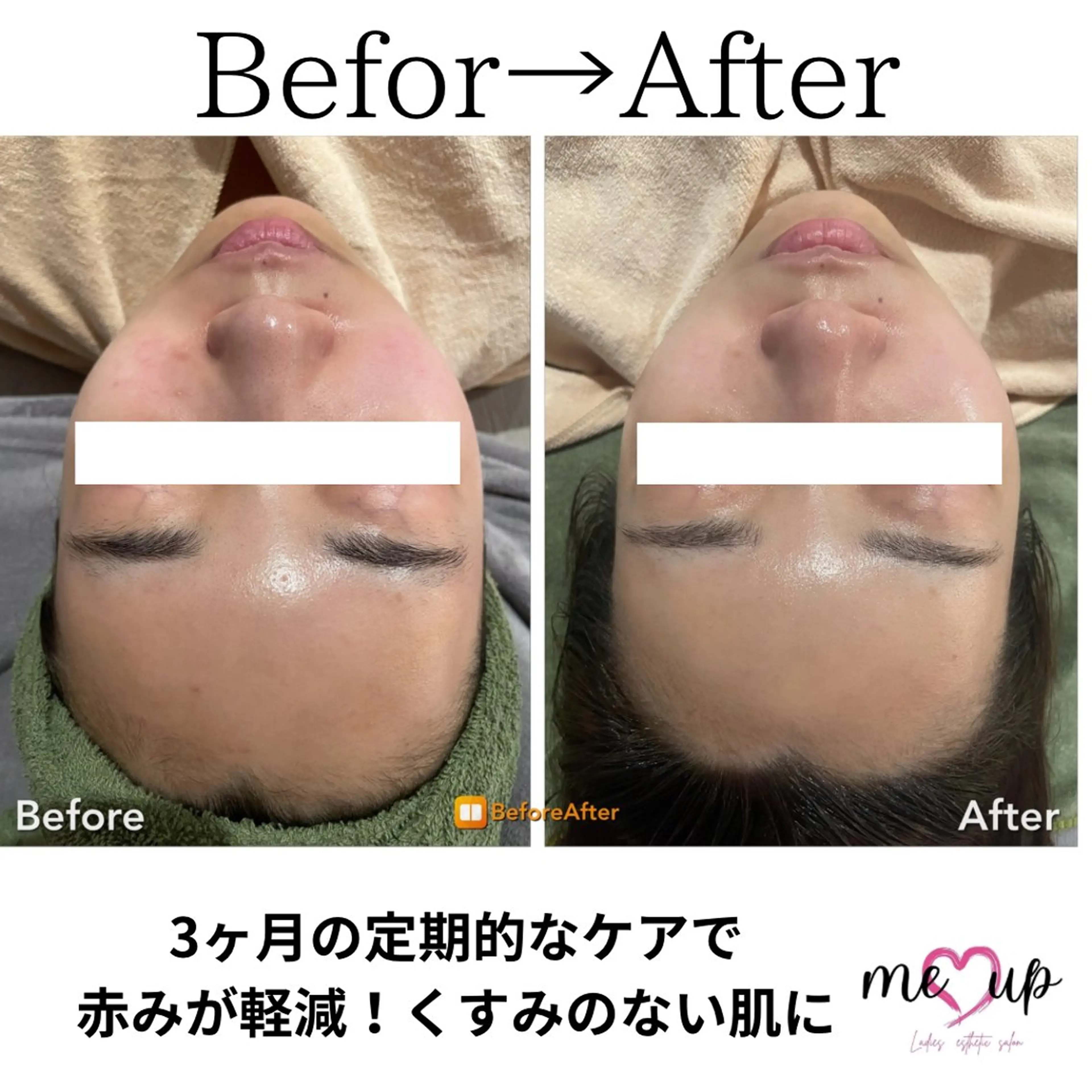 エステ Meupニキビ専門店 背中/ハーブ/ララのその他イメージ