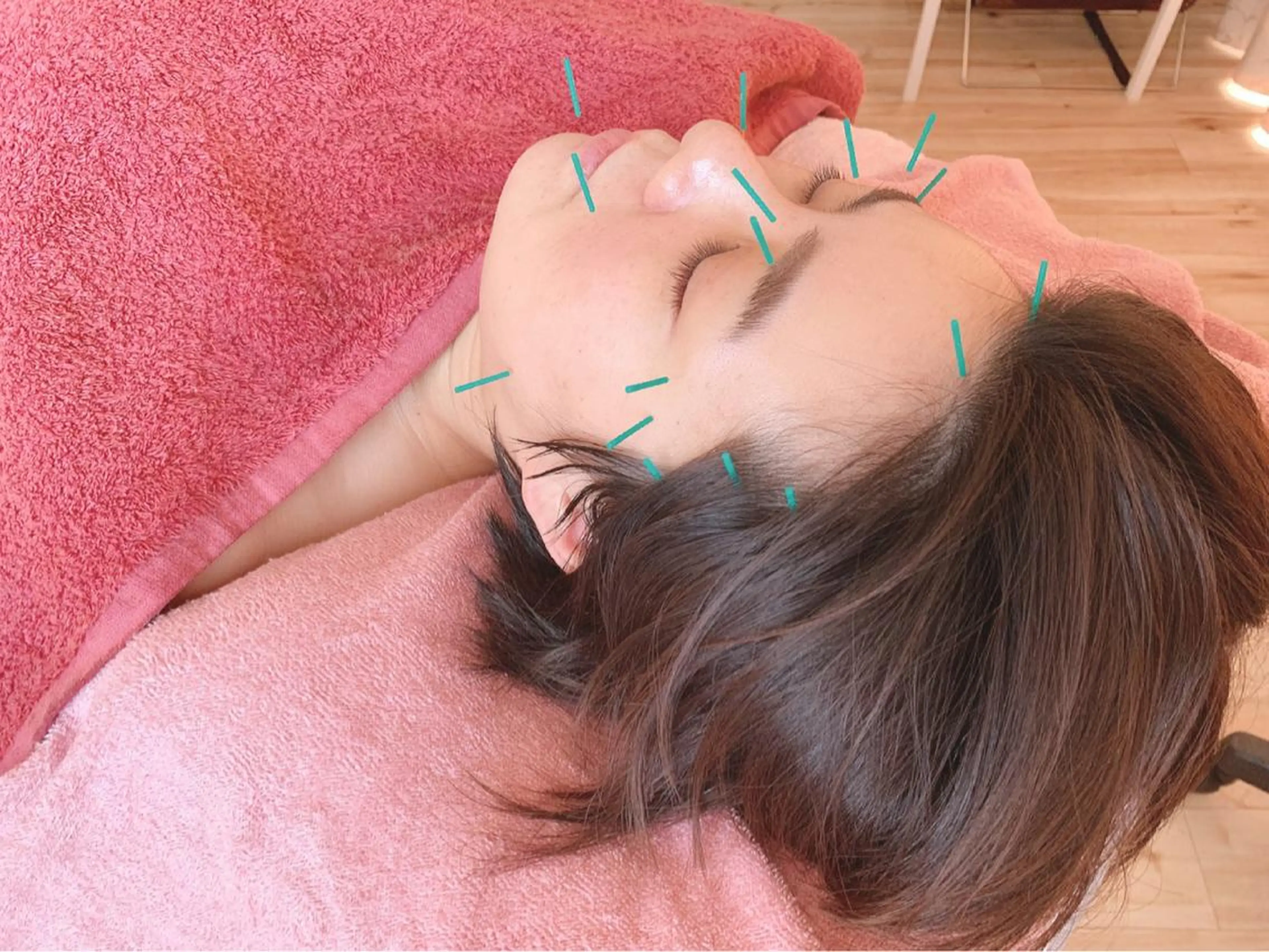 美容鍼の写真