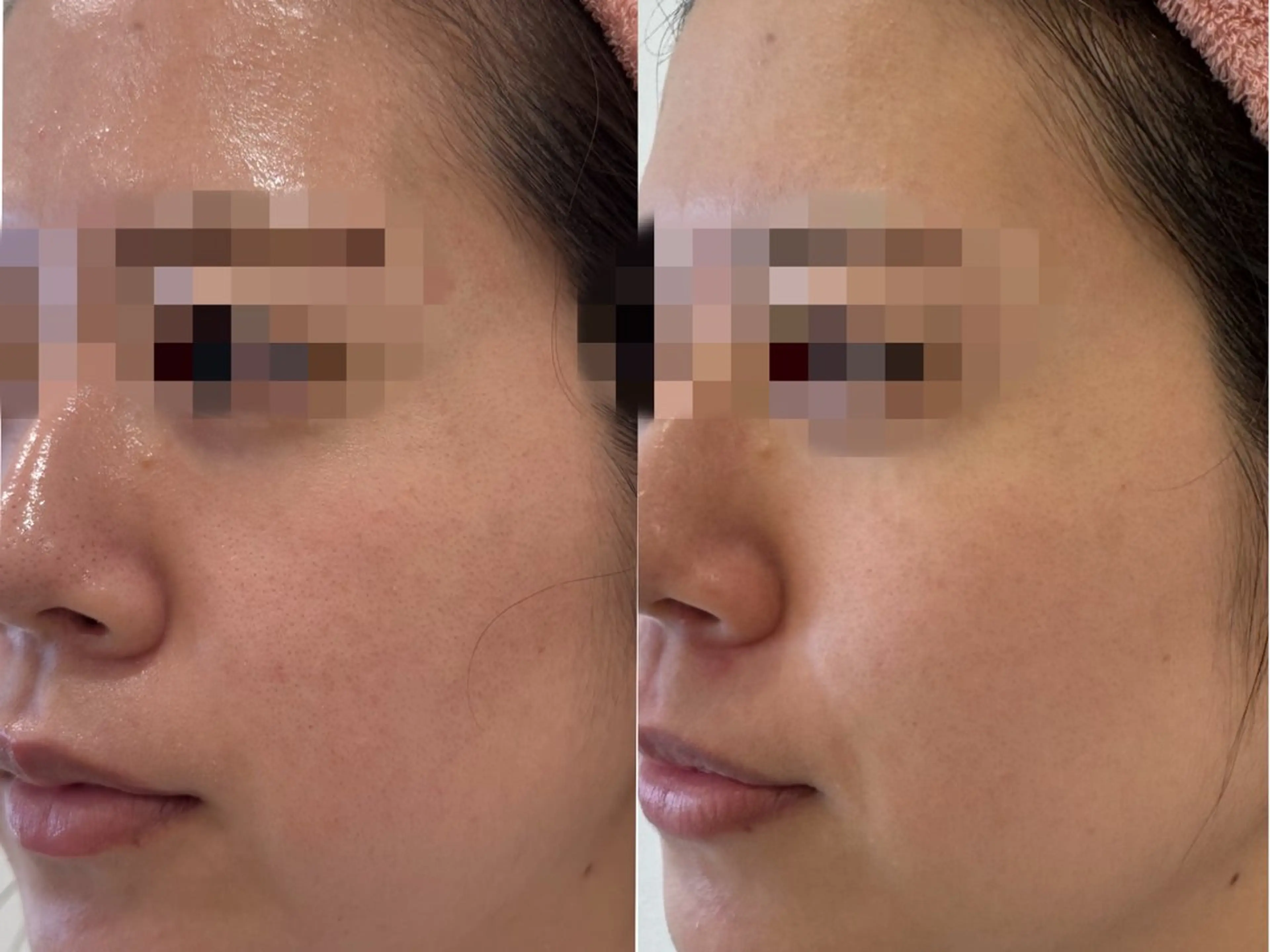 beauty salon Fee所属・毛穴開き黒ずみ ニキビ特化💆‍♀️のエステ・リラクイメージ