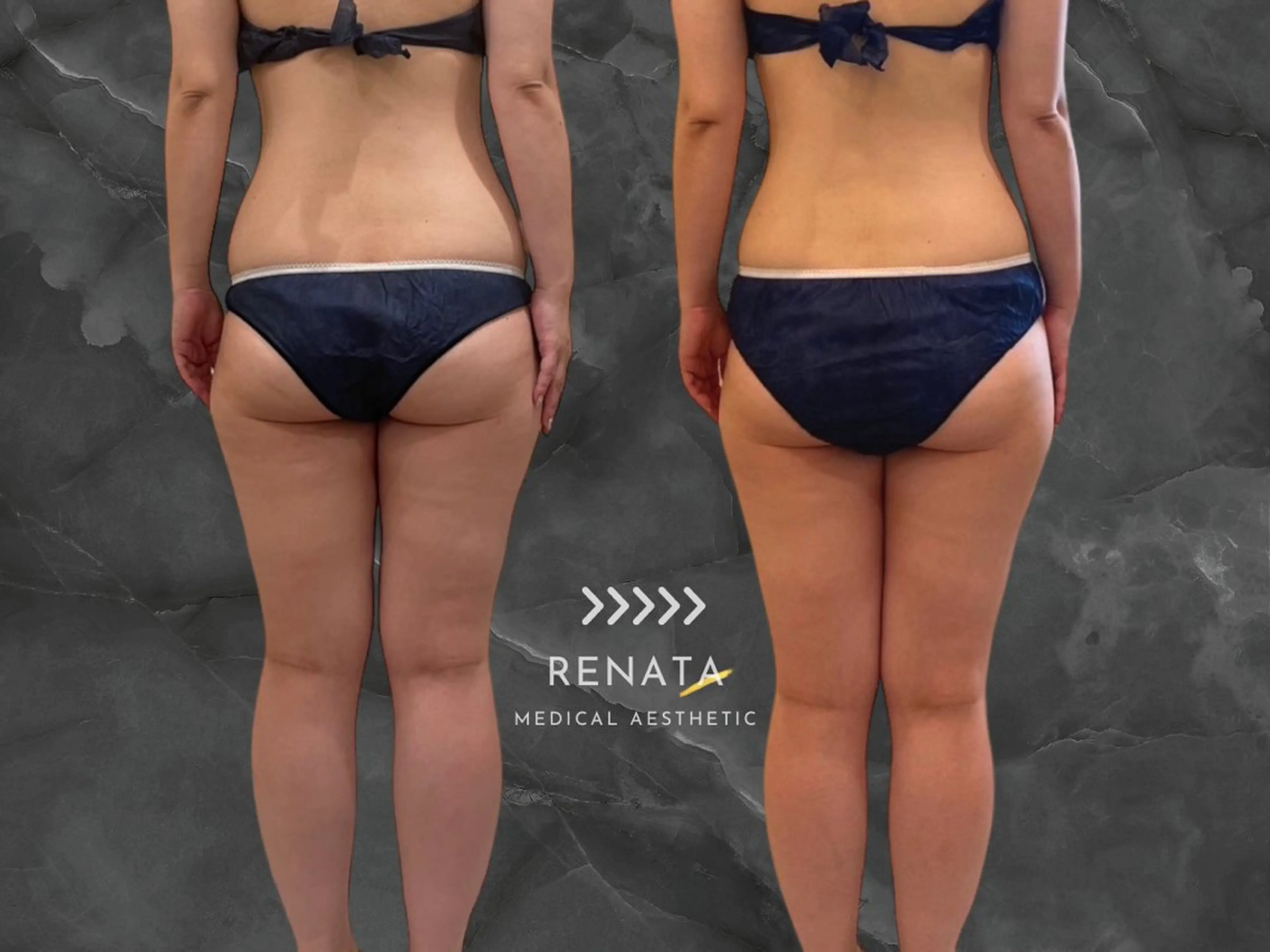 RENATA🕊 脂肪冷却専門店六本木のエステ・リラクイメージ