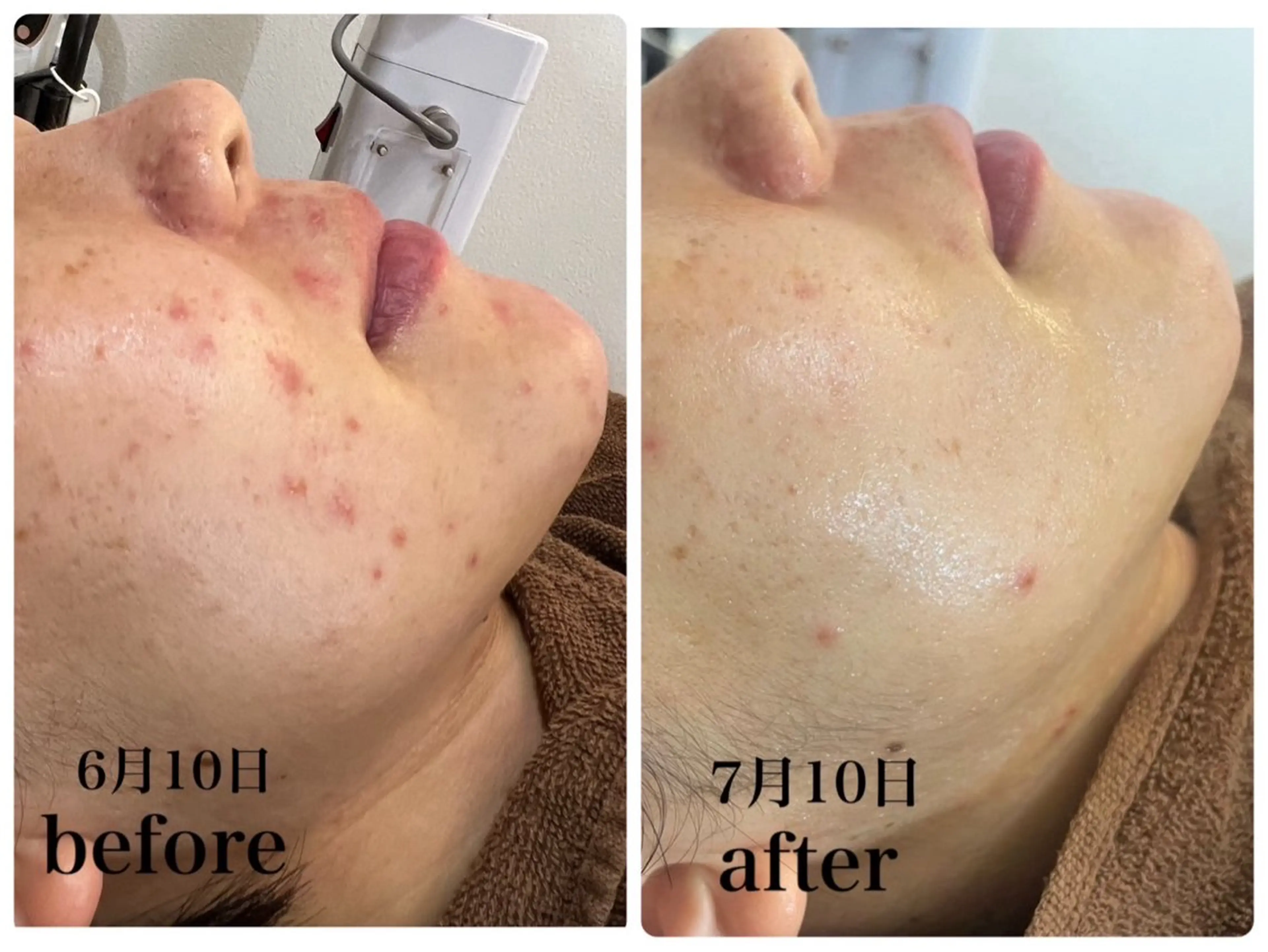 Total beauty salon Dune所属・ニキビ・肌質改善 サロンDuneのエステ・リラクイメージ