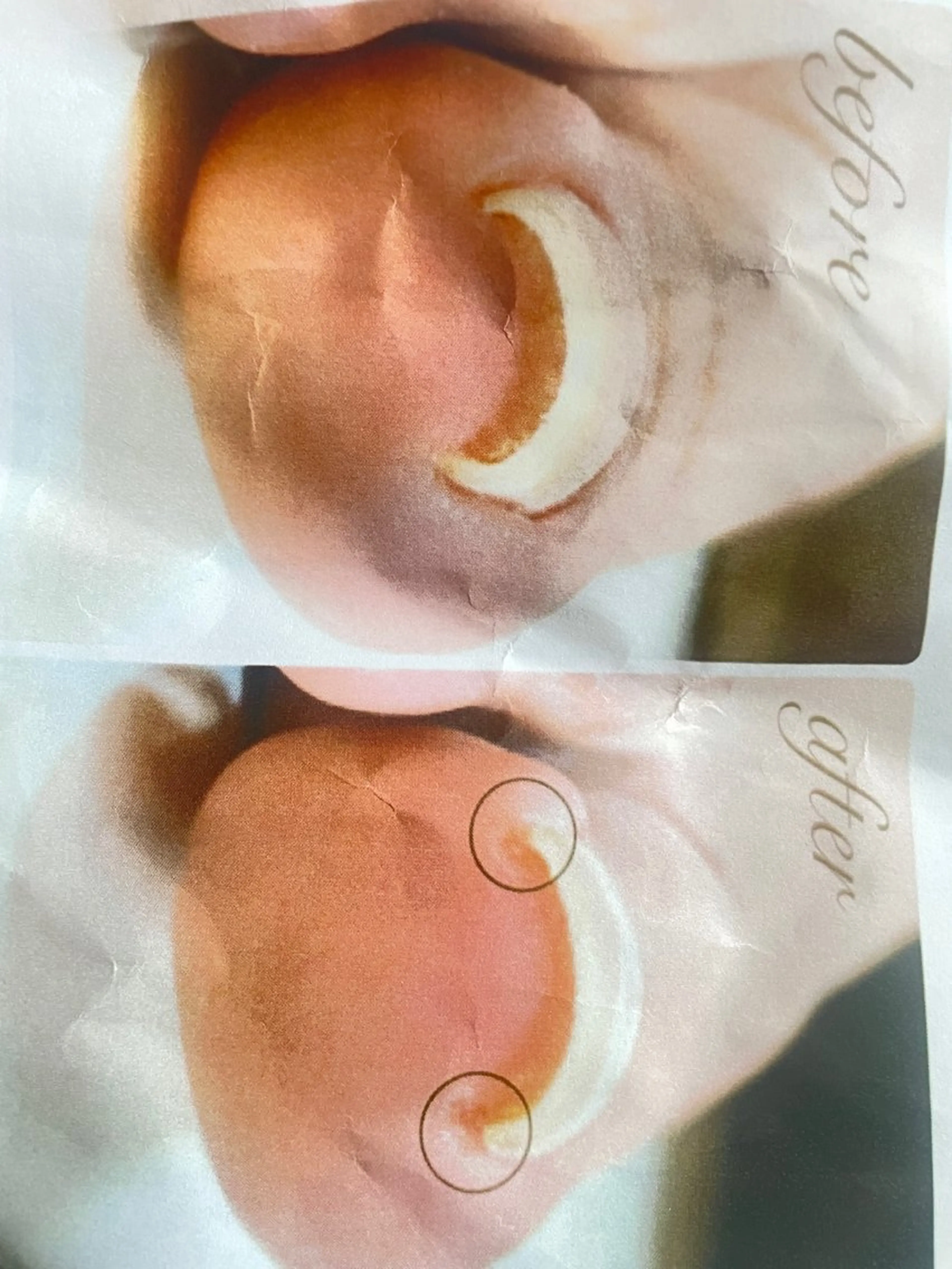 フット巻き爪矯正の写真