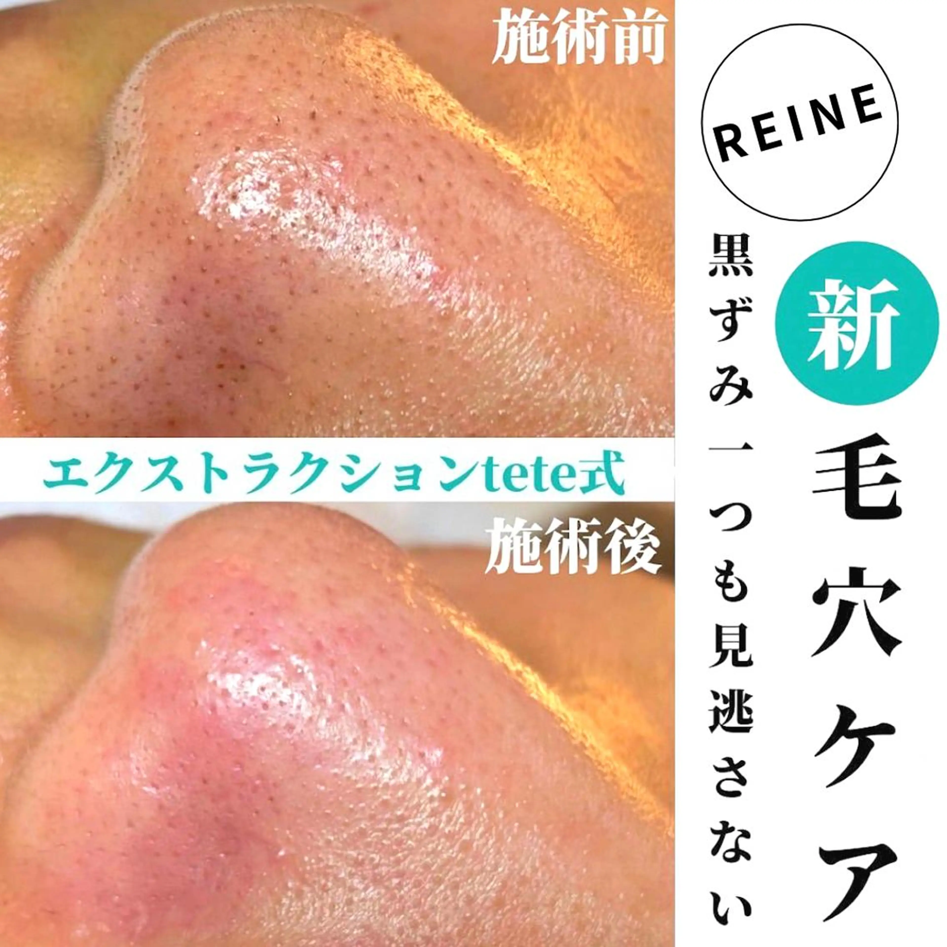 エステ Reine BeautySalon所属・毛穴/シミ肝斑/脱毛 横山梨里のエステ・リラクイメージ
