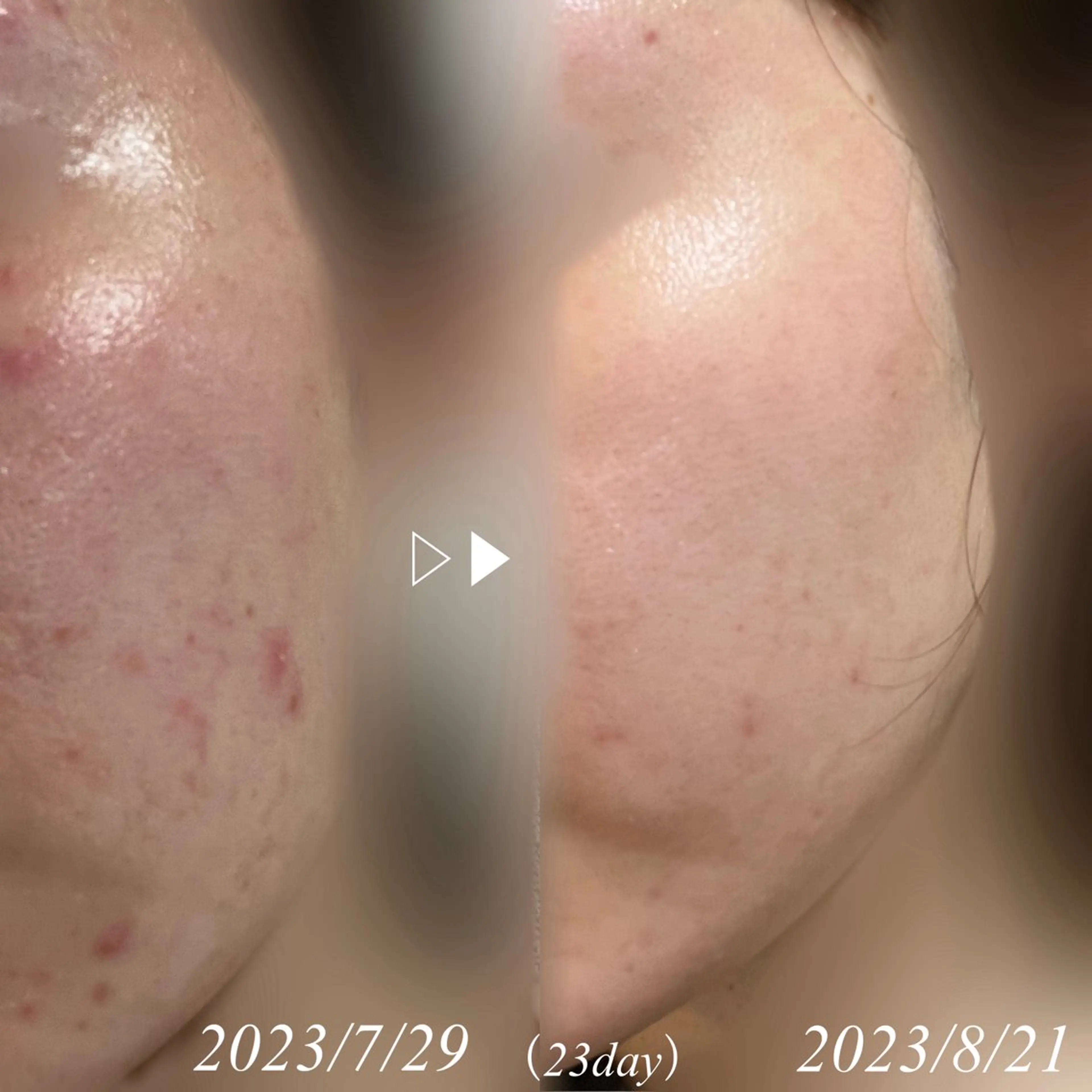 【その場で作る本格生パック使用‼️】                      本気の肌質改善エステ🤍の写真