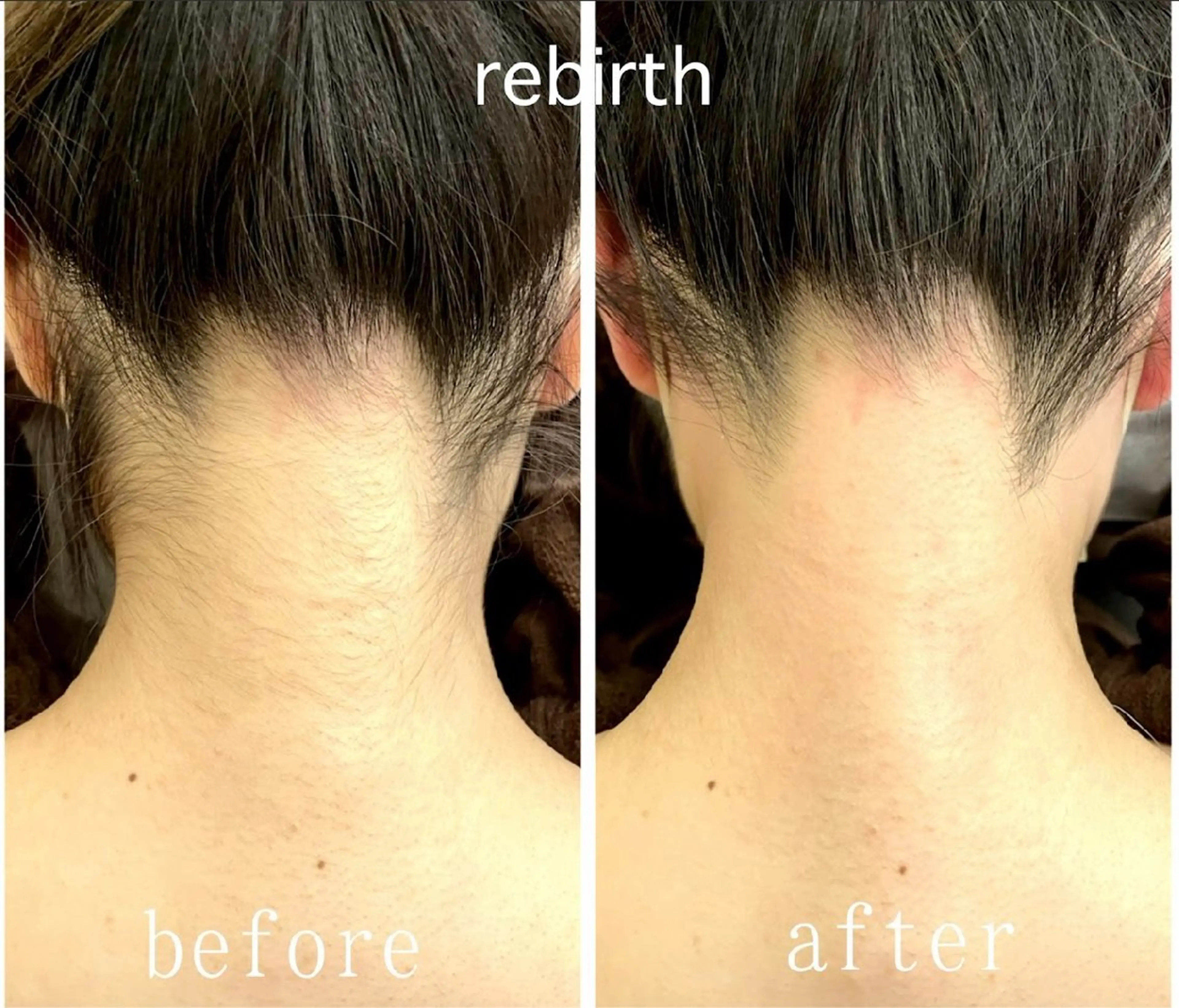 【和装・成人式前】うなじ＆もみあげセットのワックス脱毛の写真