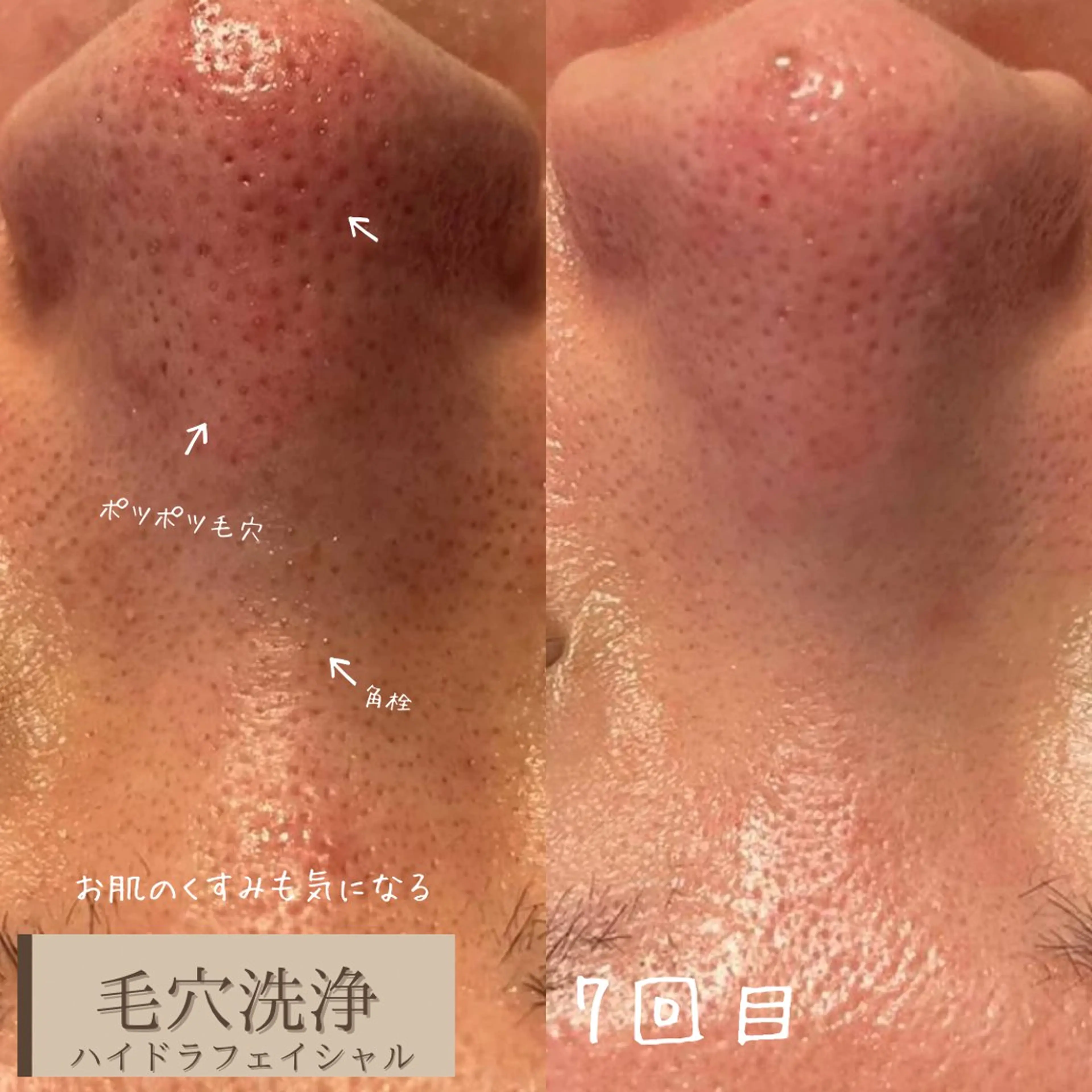 ⭐️ハイドラ【毛穴洗浄】をしながら美容導入🌈（無料施術！！）の写真