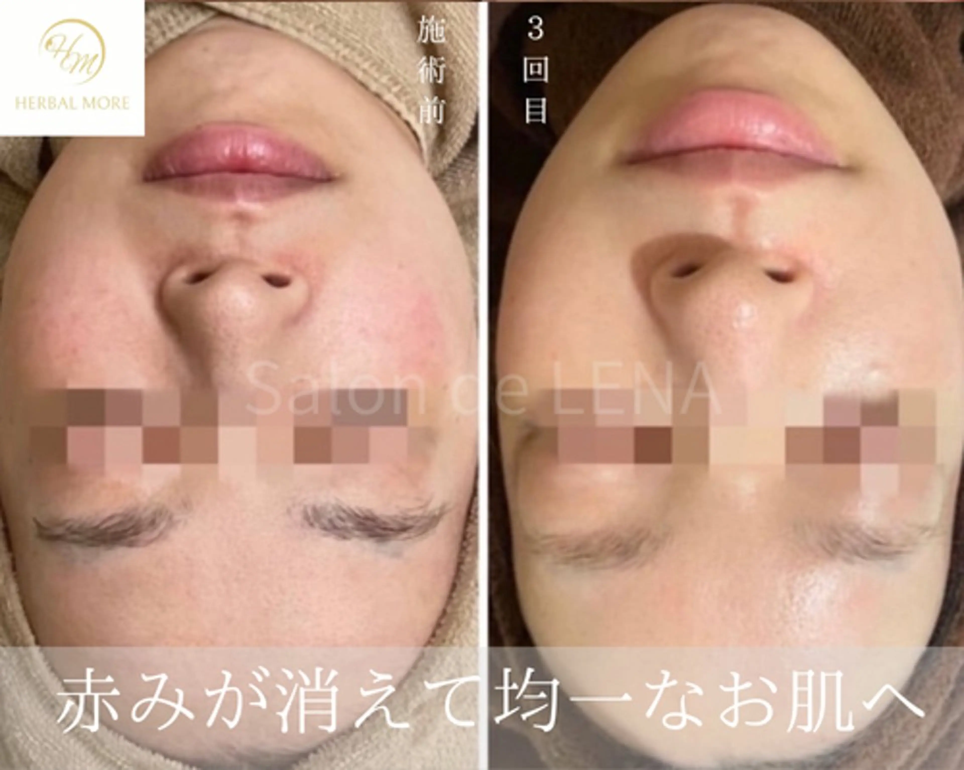 【平日10時〜15時限定】顔用/剥けない幹細胞ハーブピーリングの写真