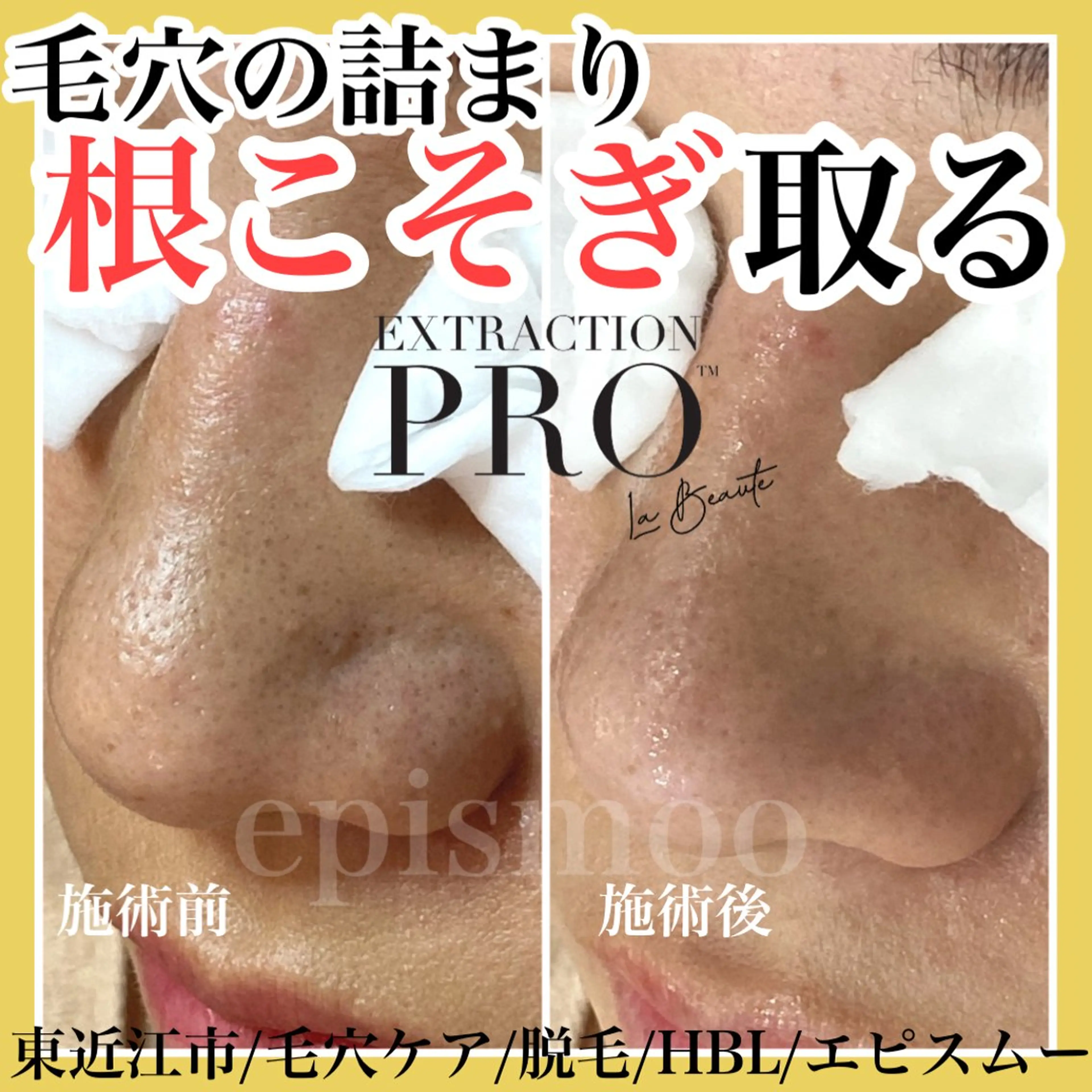 epismoo 脱毛/HBL/毛穴の眉毛・アイブロウイメージ