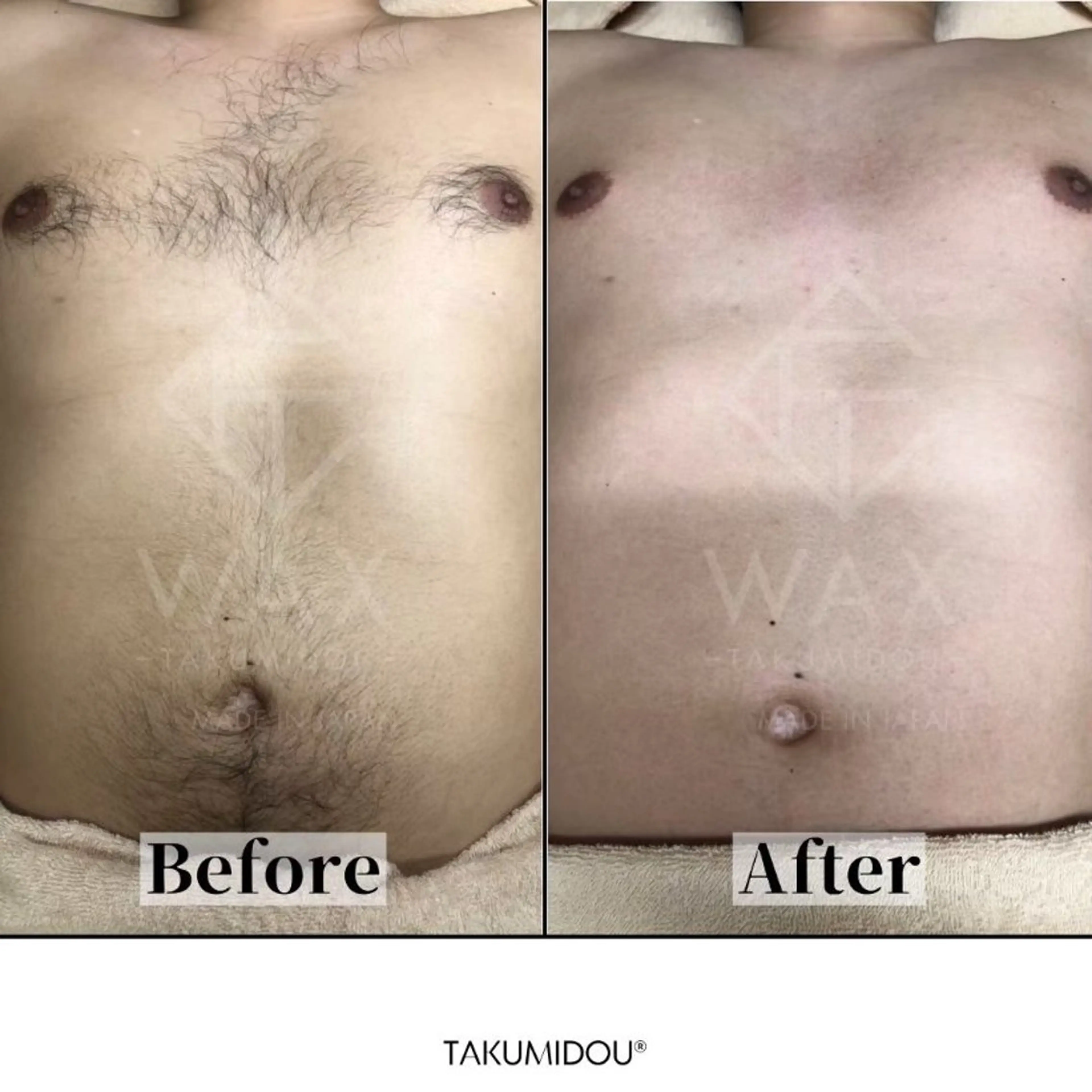 🩵男性WAX🩵胸からヘソ周りを清潔に！ムダ毛すっきりで好印象ボディへ🌱✨の写真