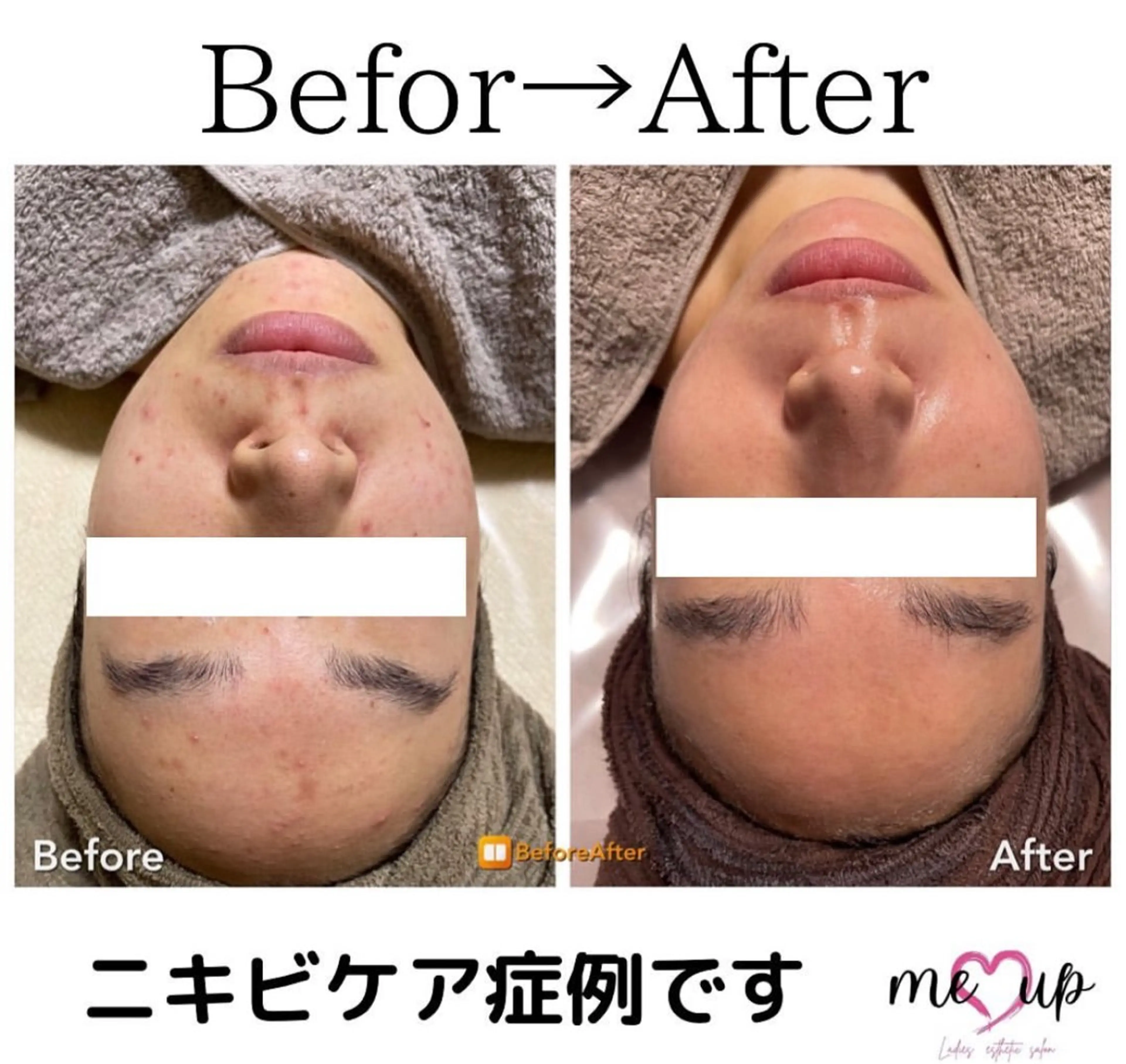 Meupニキビ専門店 背中/ハーブ/ララのその他イメージ