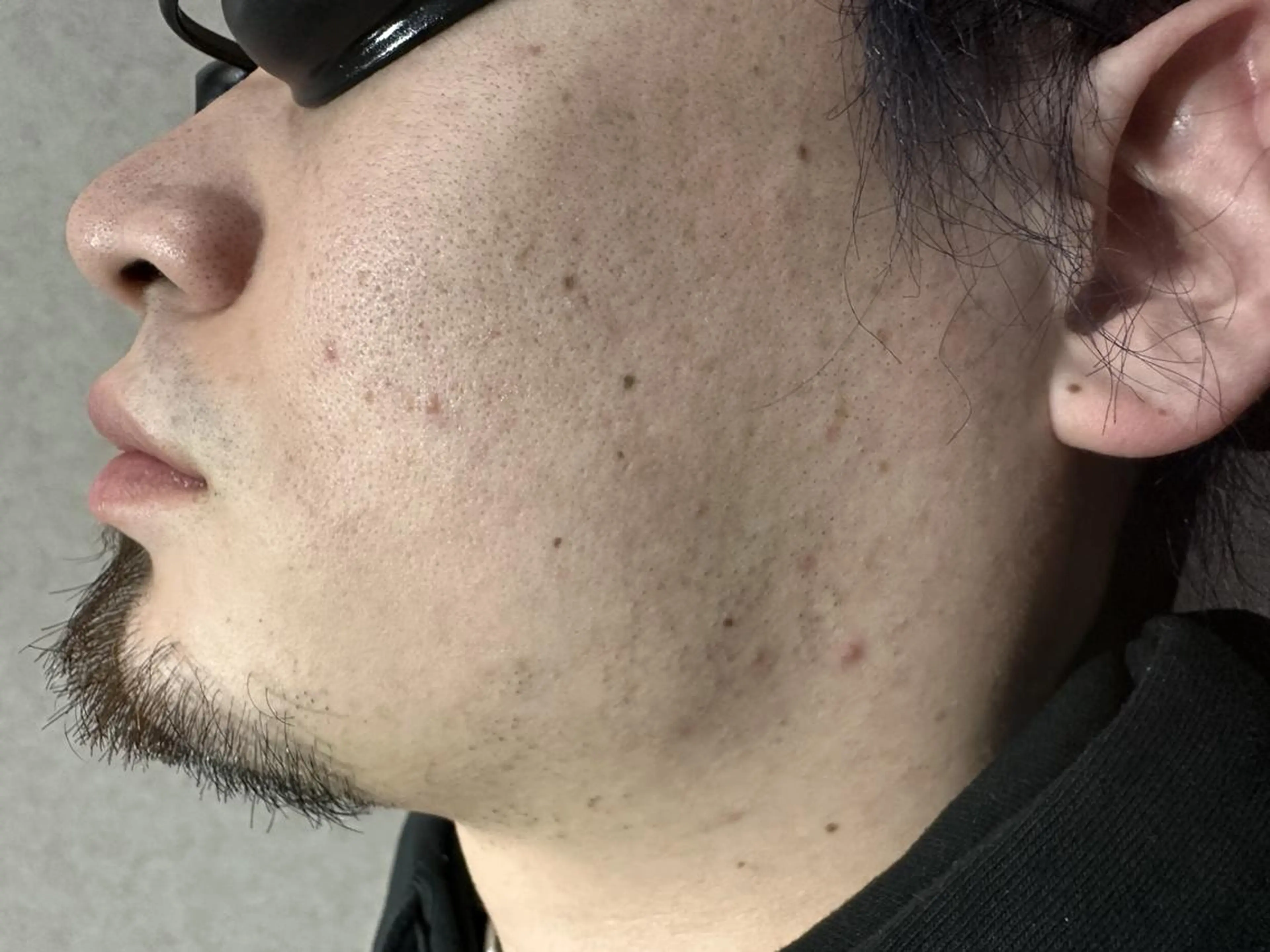 メンズ 20代から始める脱毛 salonLEPIAのエステ・リラクイメージ