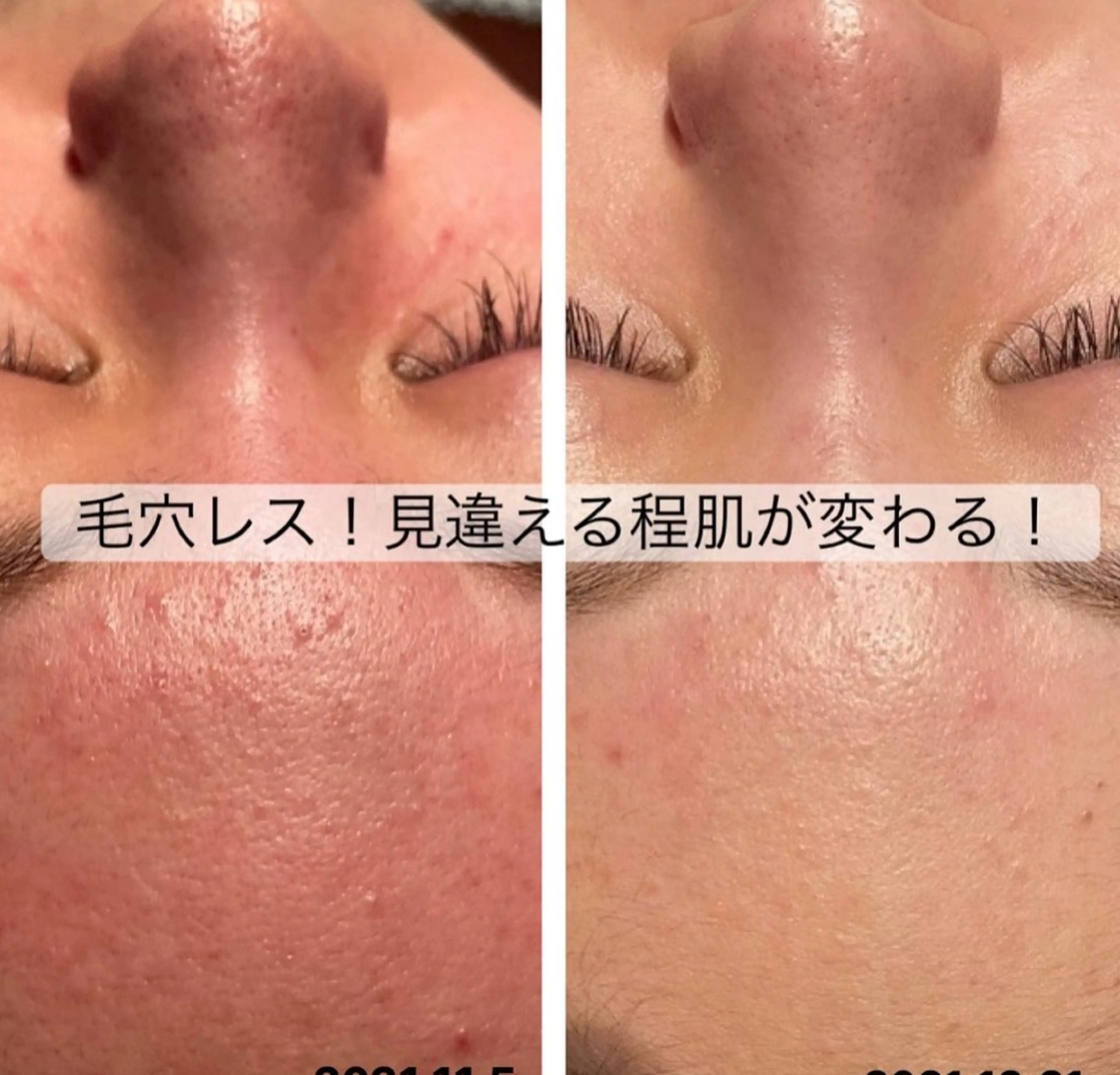 ハーブピーリング re:proのエステ・リラクイメージ