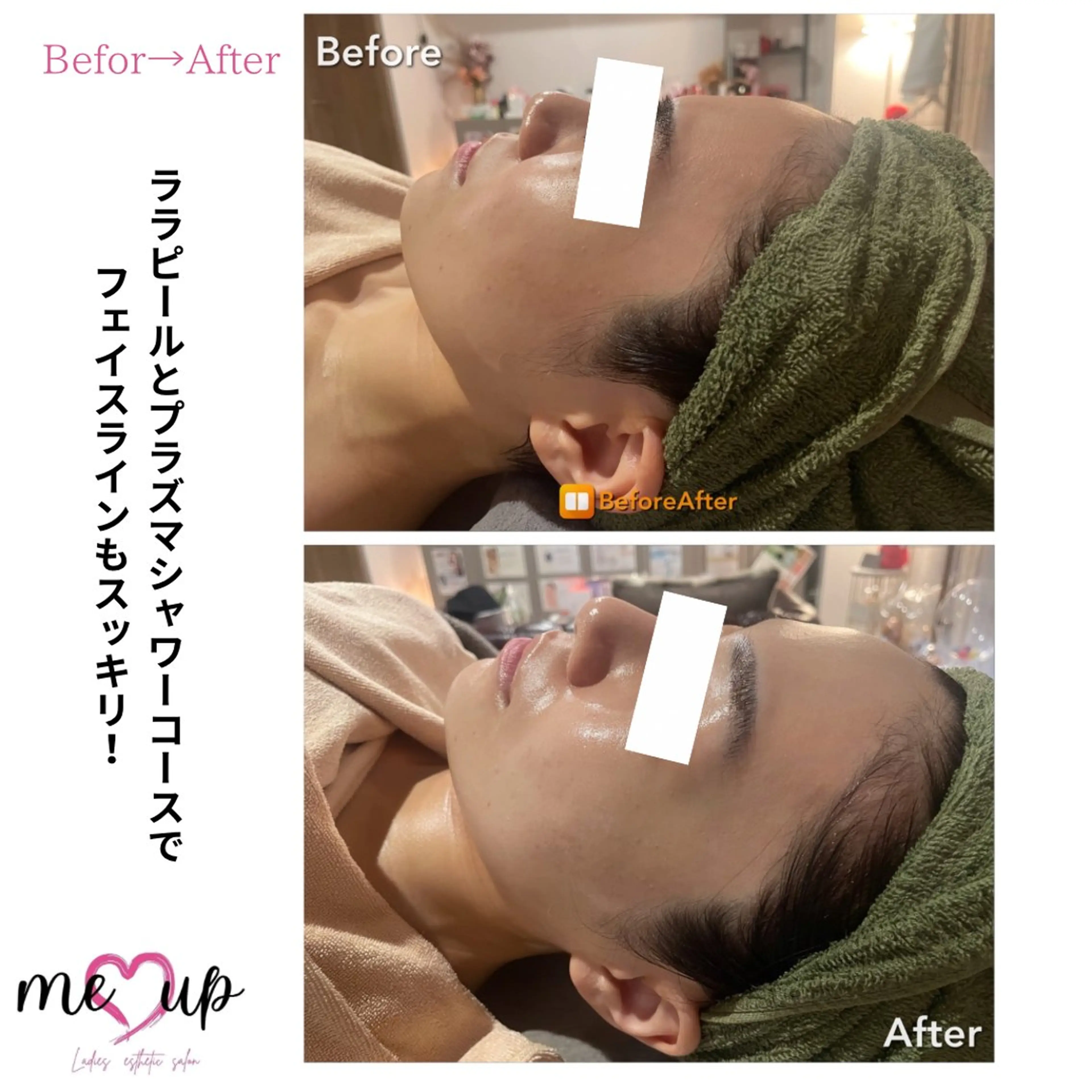 エステ Meupニキビ専門店 背中/ハーブ/ララのその他イメージ