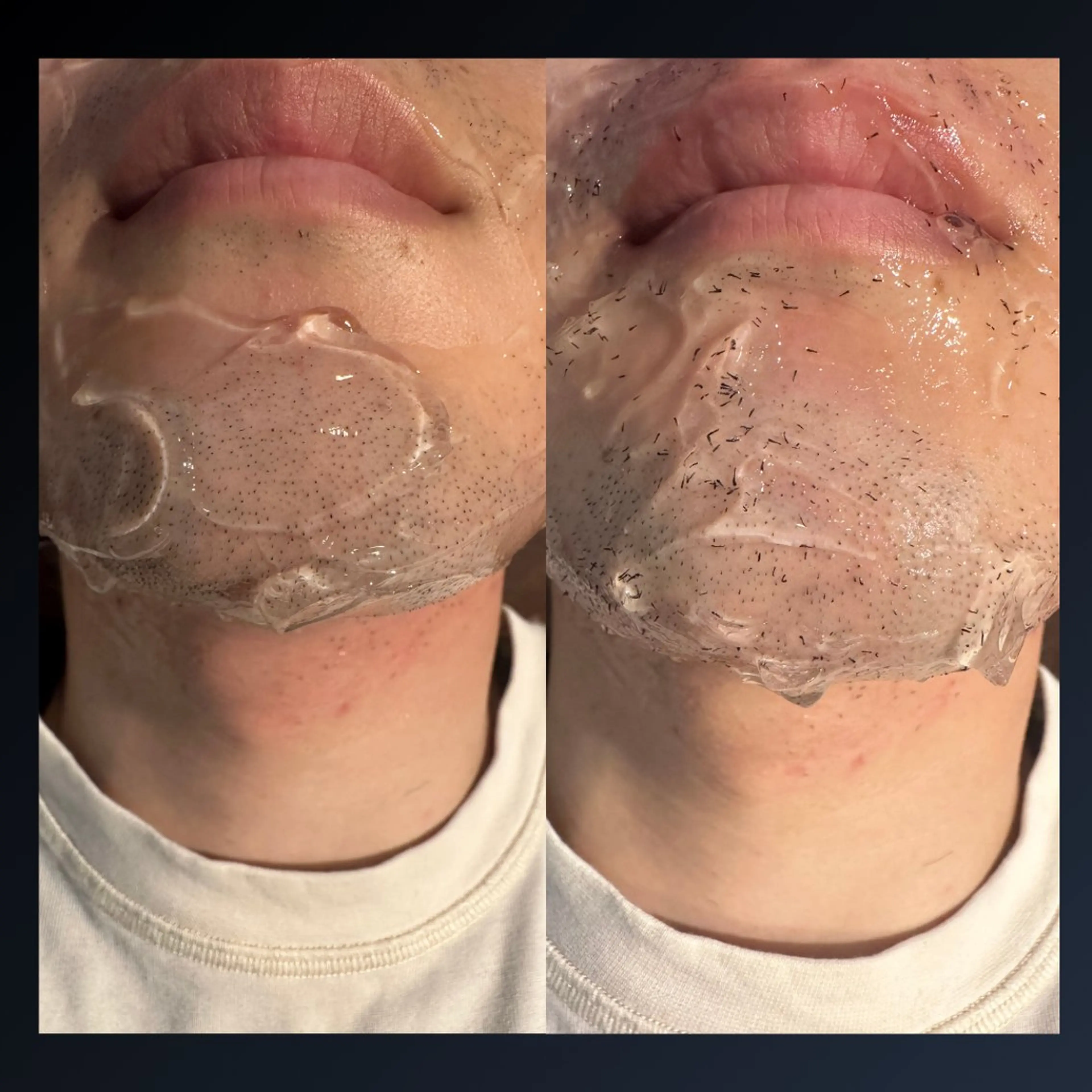 【残り4名様】メンズNo.1メニュー                    その場で抜ける髭脱毛の写真