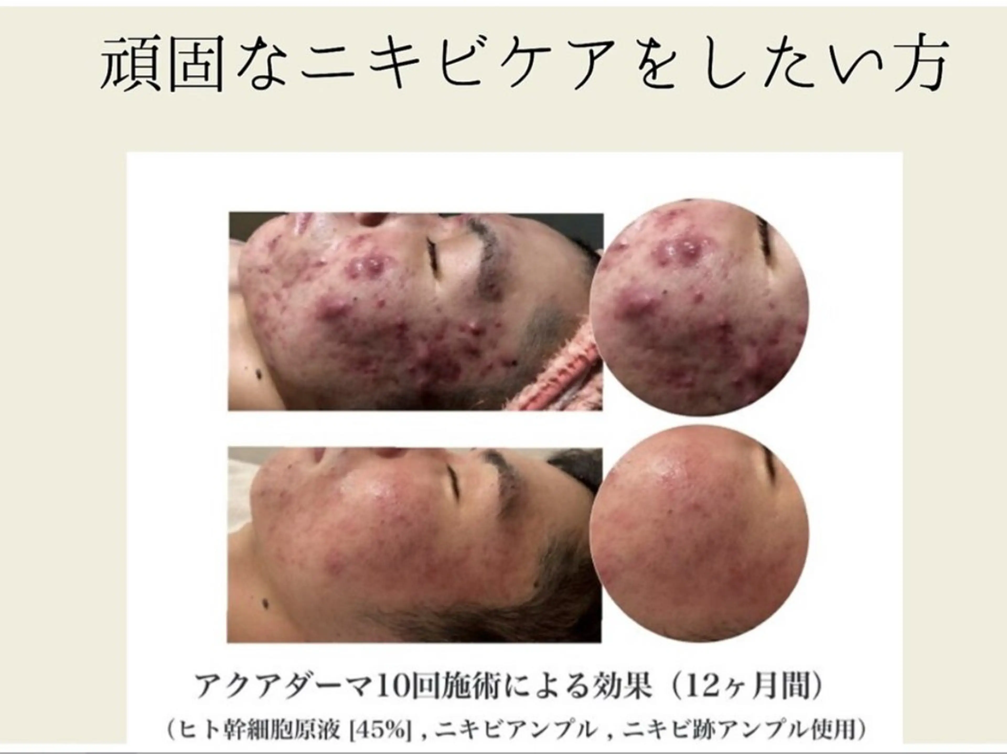 【荒れた肌を速攻鎮静】高濃度ニキビケア美容液で肌トラブルを根本から改善！の写真