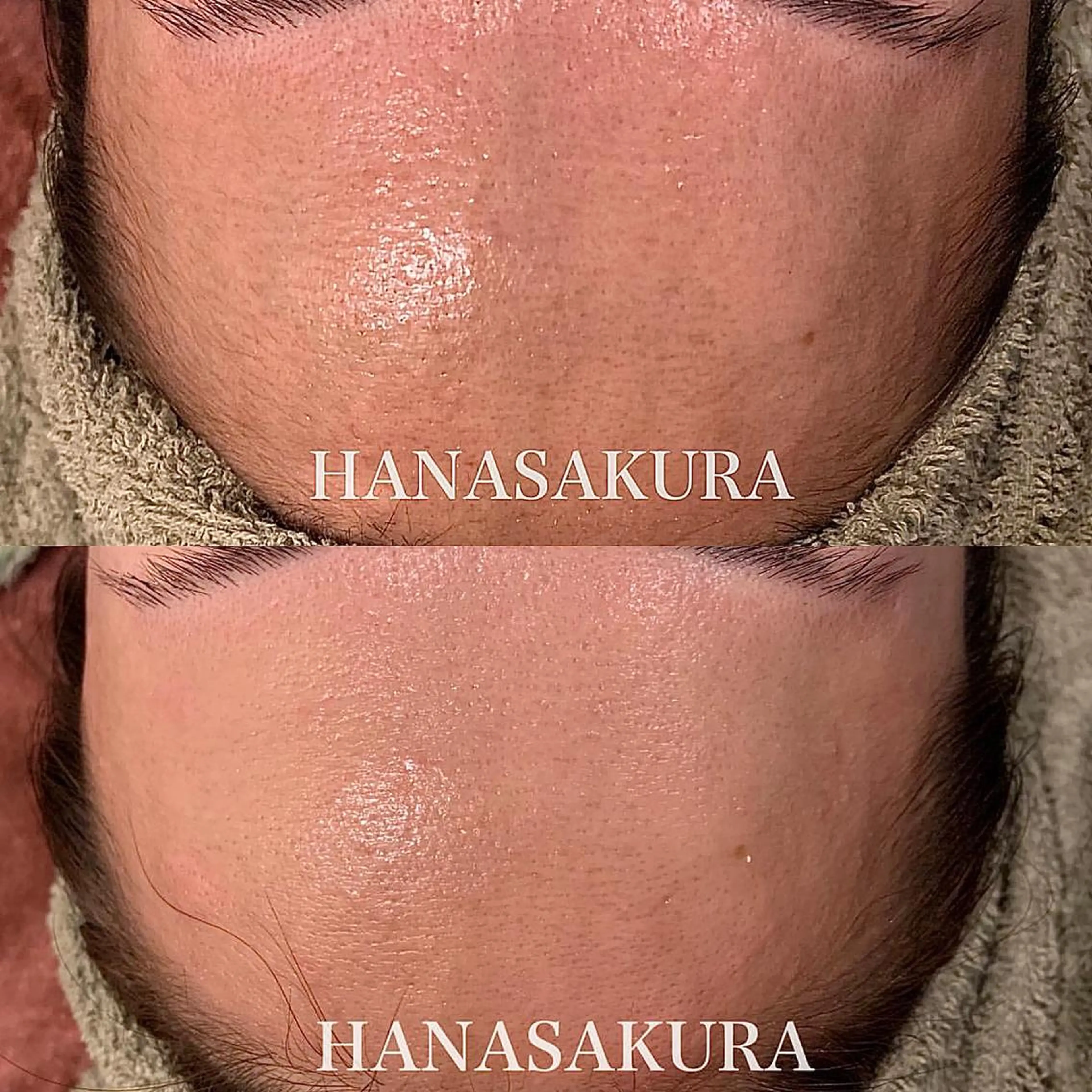 脱毛 HANASAKURA所属・HANASAKURA 心斎橋のエステ・リラクイメージ